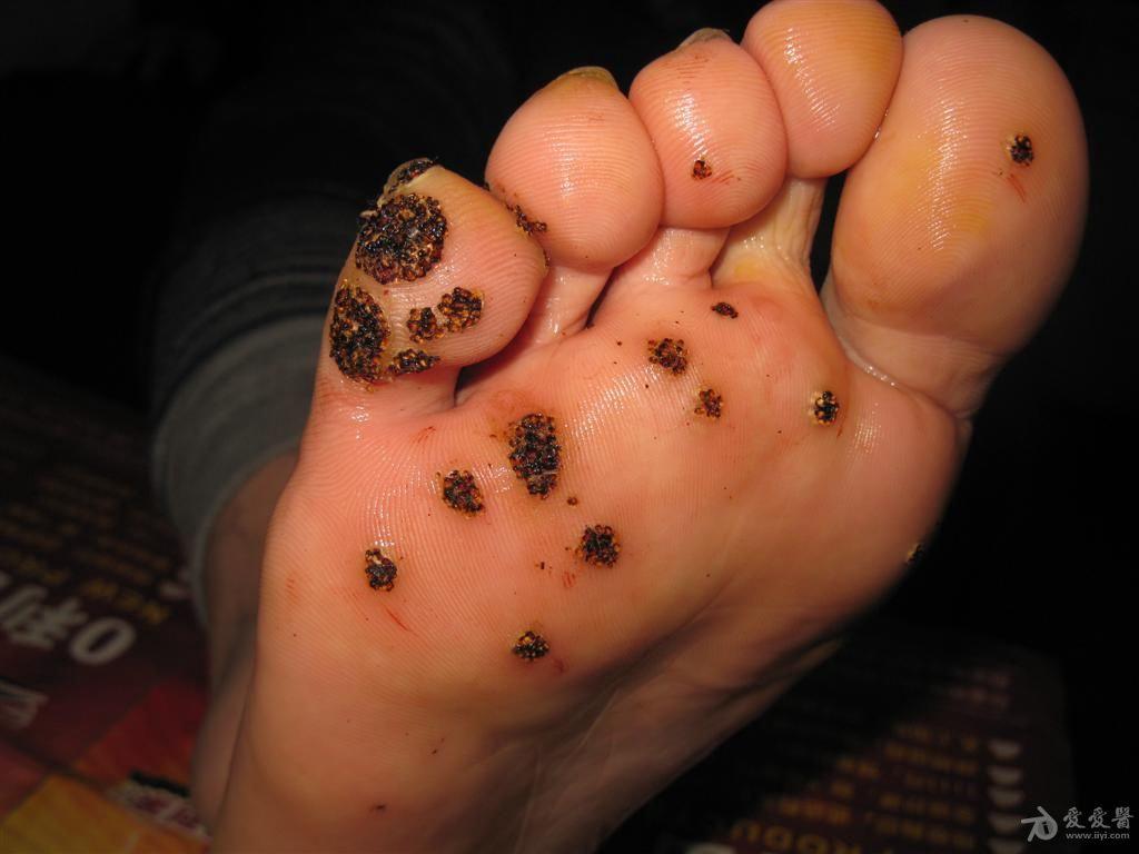 高频点灼加涂药治疗多发性跖疣又一帖