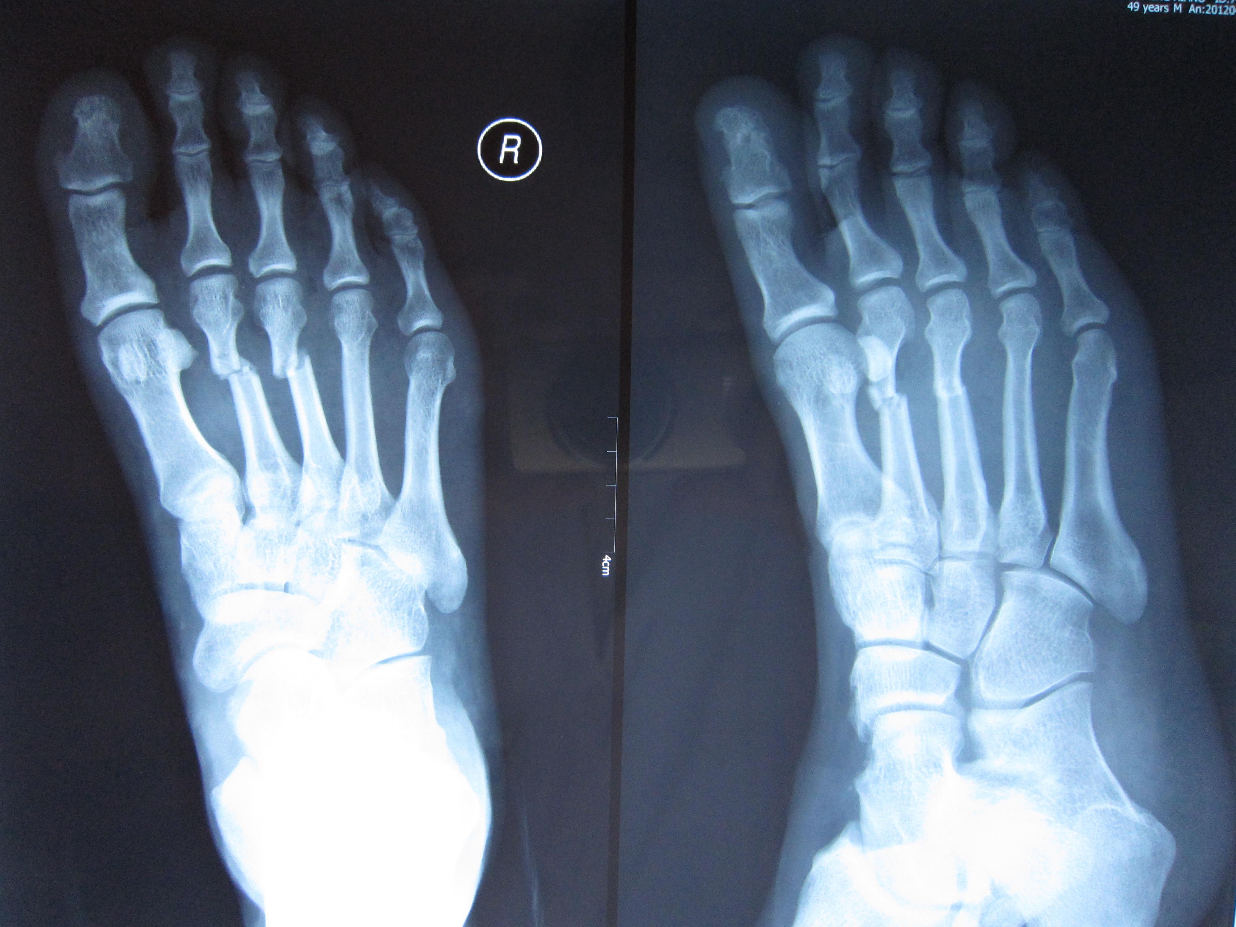 正常的脚趾骨x光图片图片