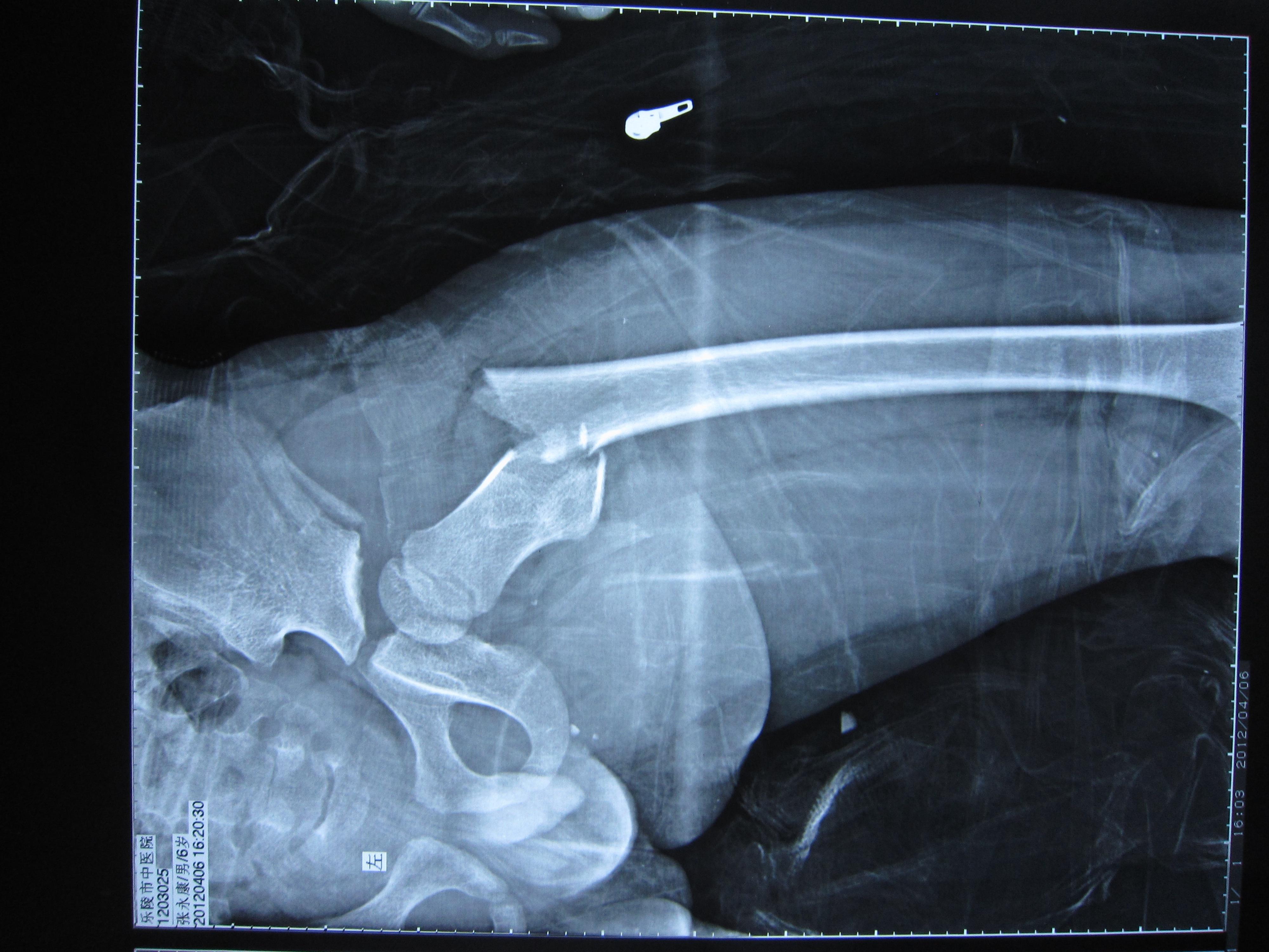 一例儿童股骨转子下骨折