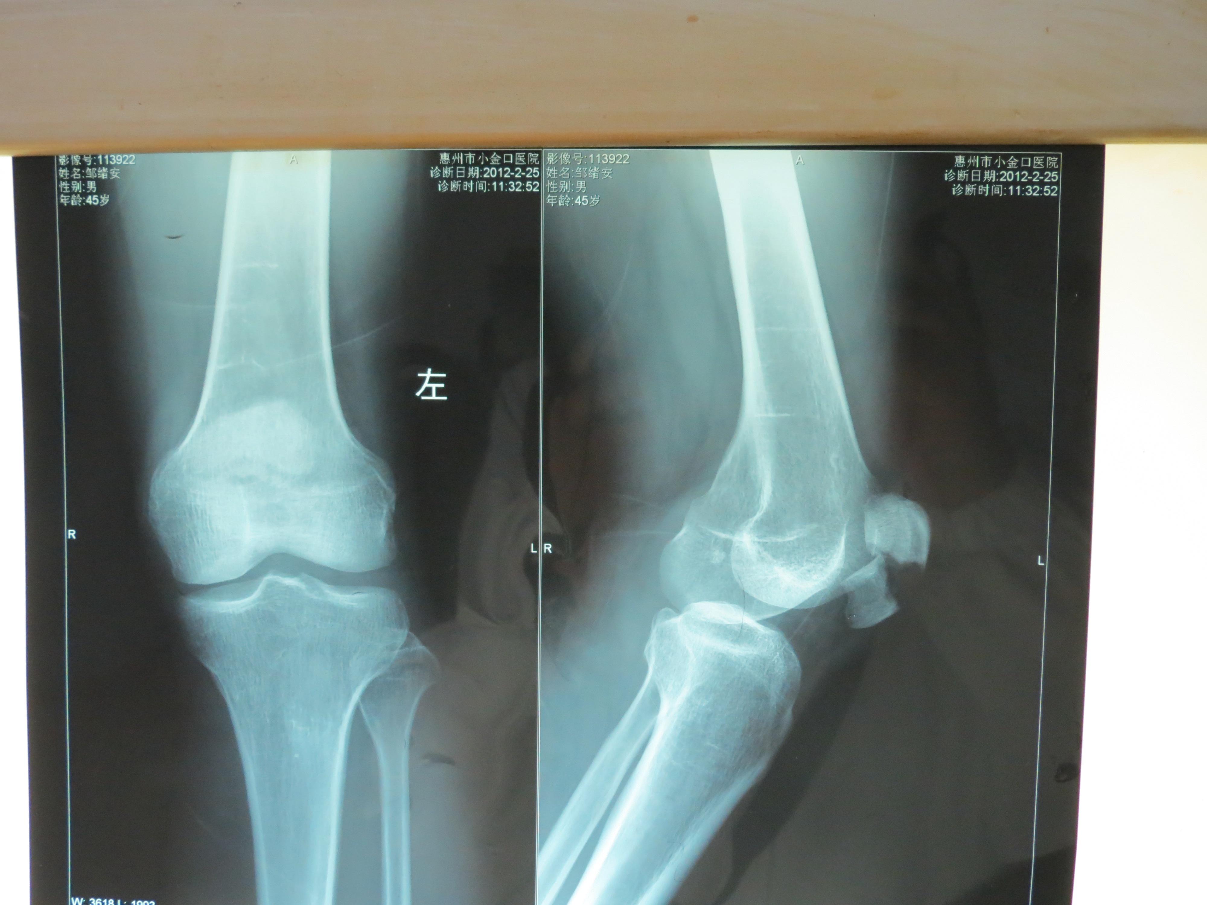 膝盖骨折图片 片子图片