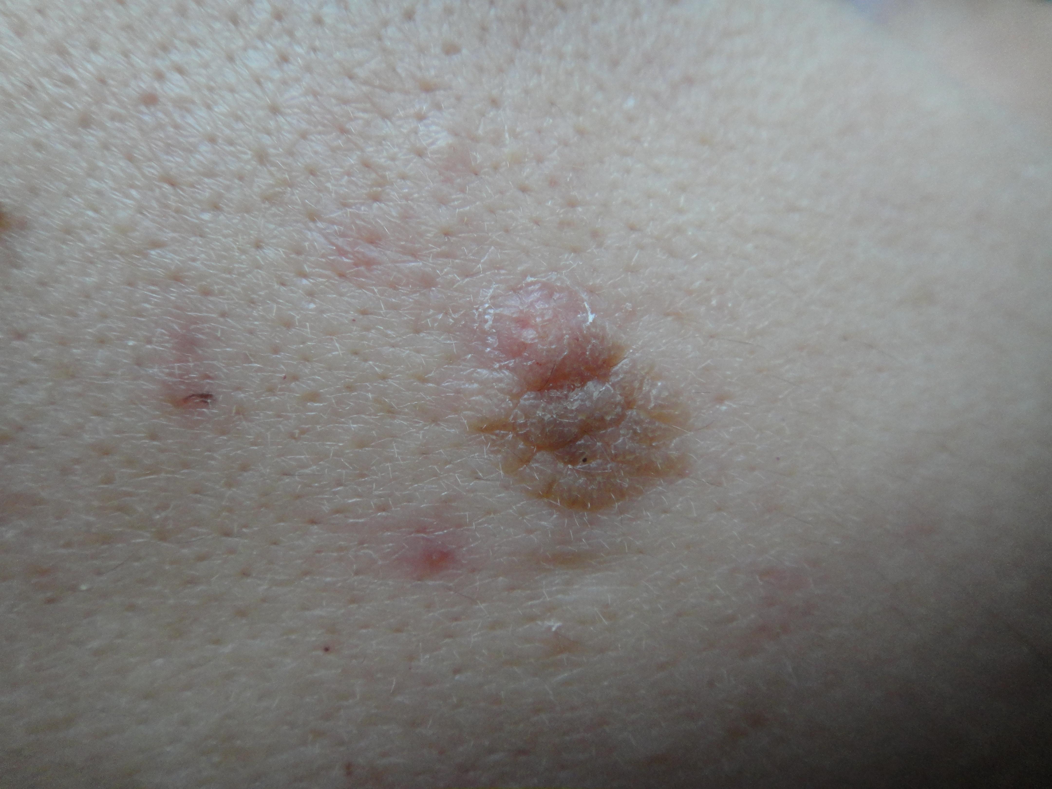 面部皮肤丘状物求诊断和治疗方法