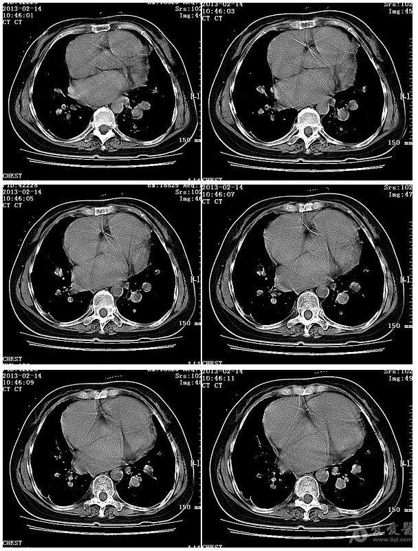 心脏ct片子诊断的图片图片