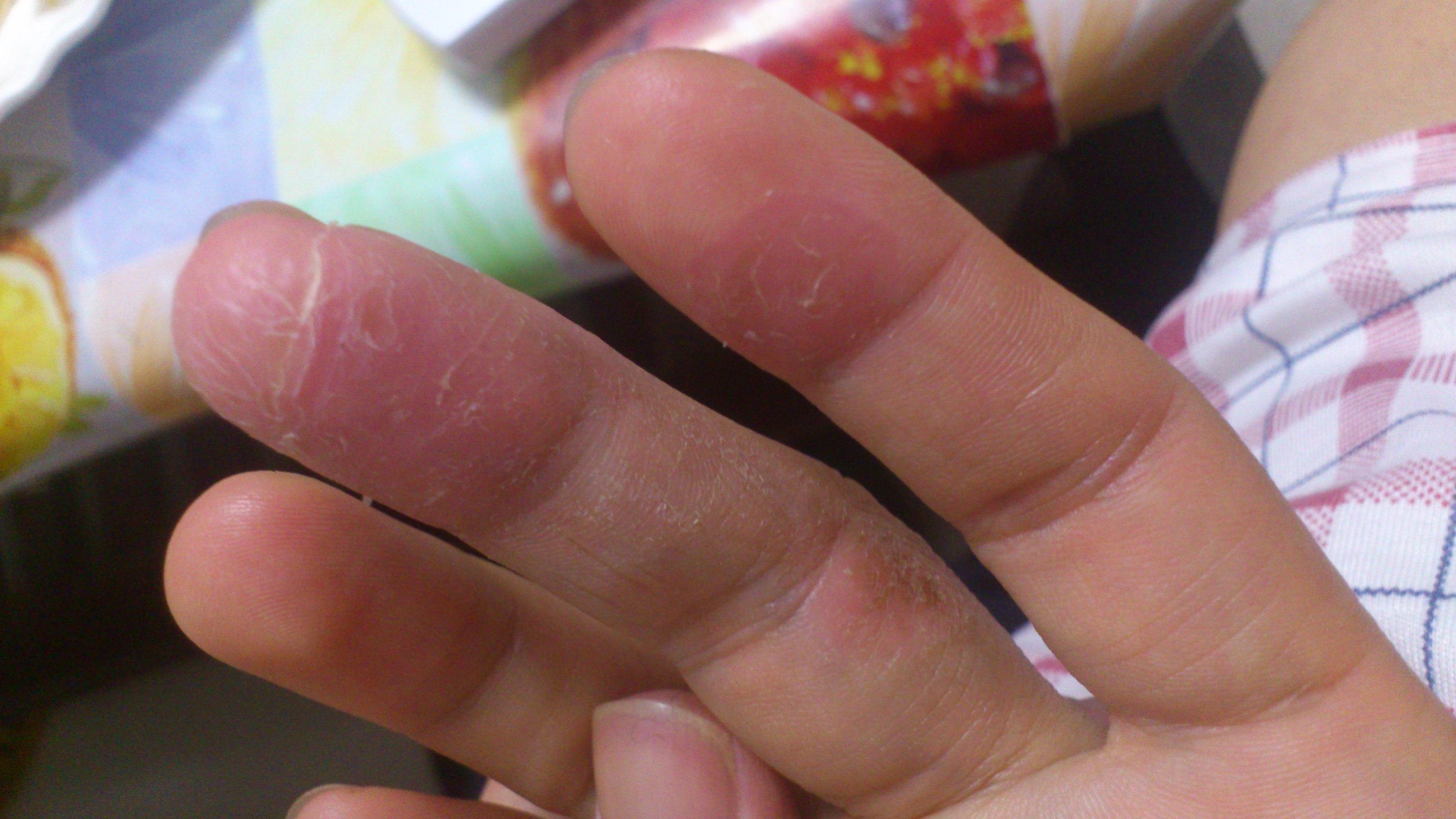 皮肤裂开脱皮,接触天那水后造成的