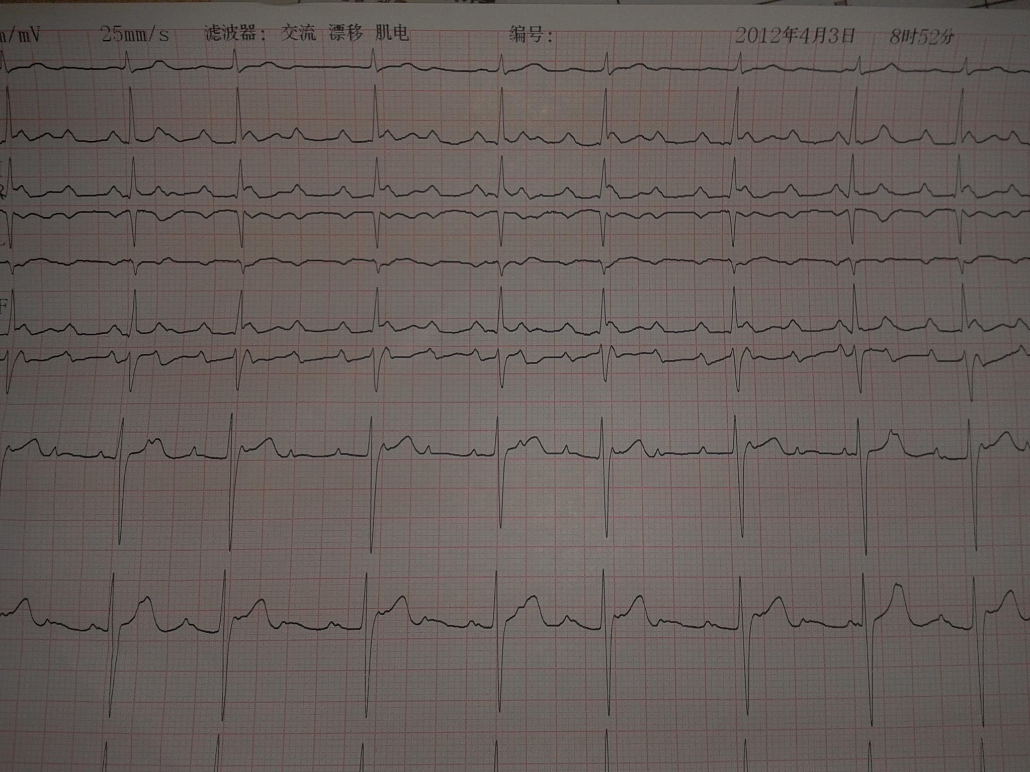 3度房室傳導阻滯,交界性逸搏心律,st段改變2-2.jpg