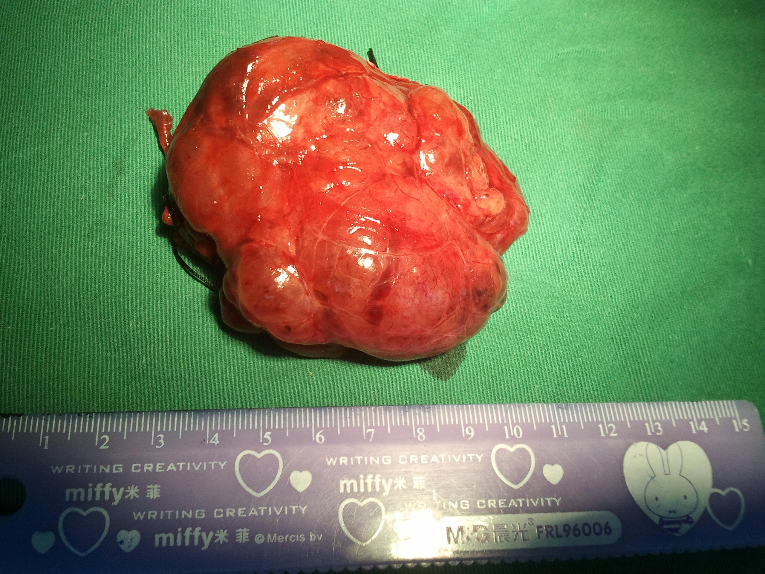 结节性甲状腺肿并甲亢