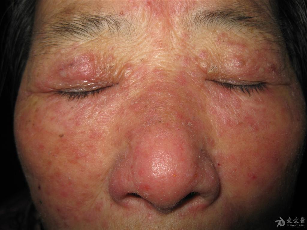 这是什么皮肤病蠕形螨病