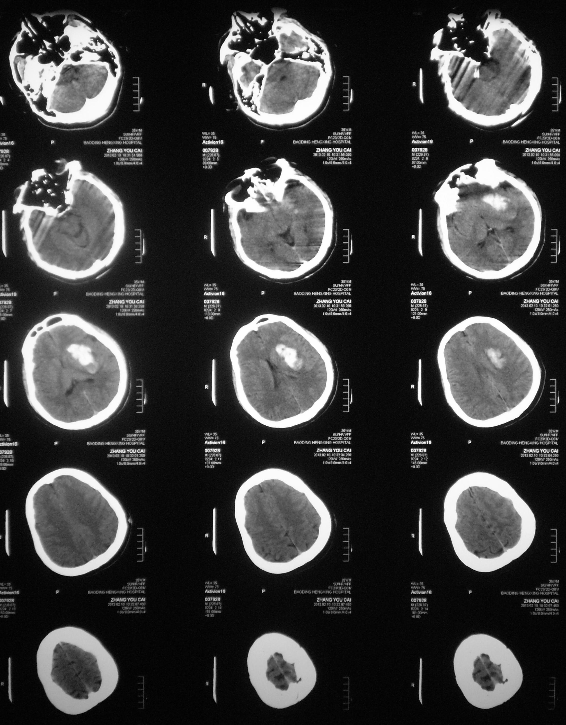 脑溢血ct病例图片图片