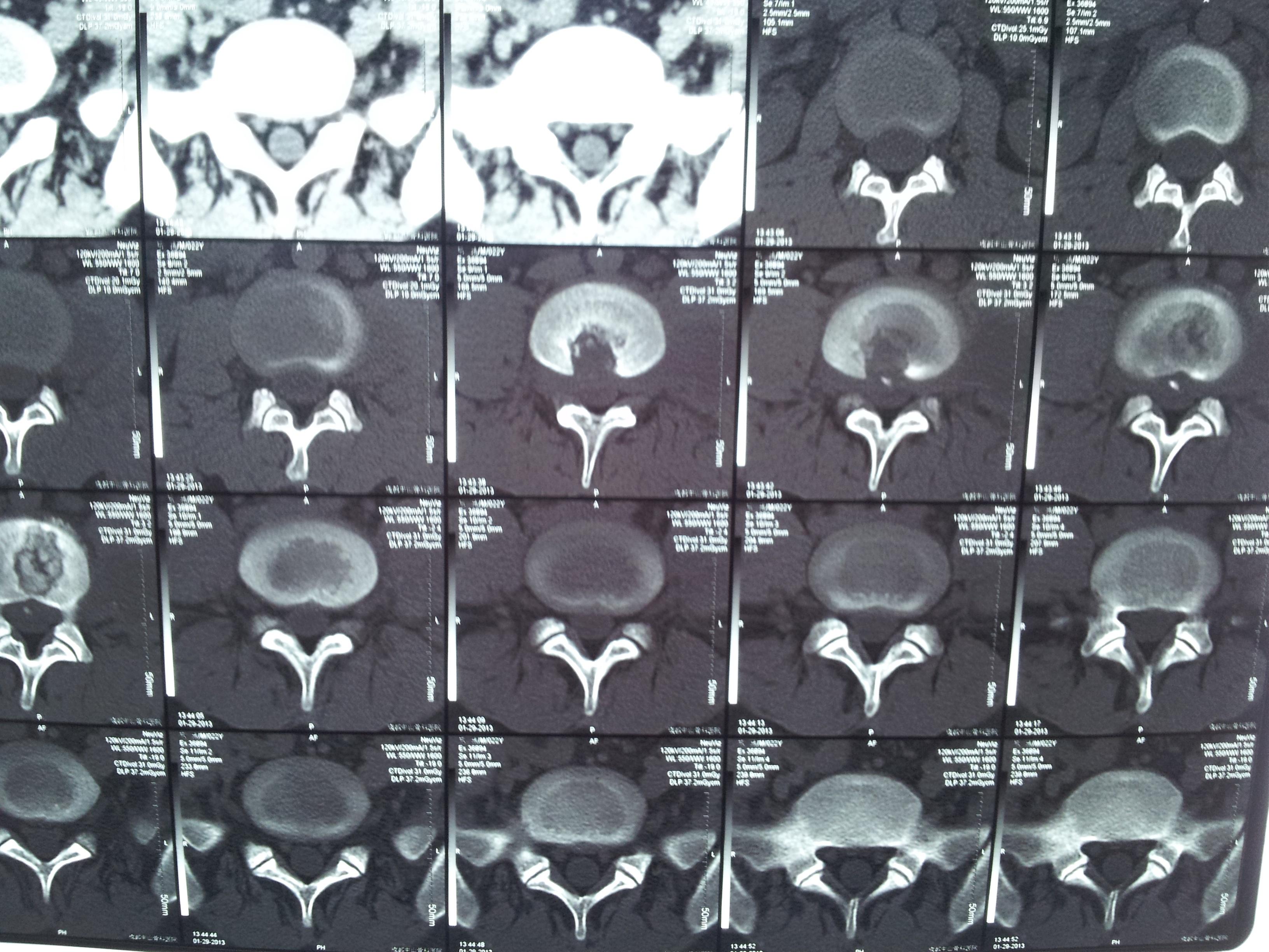 腰大肌脓肿CT图片图片