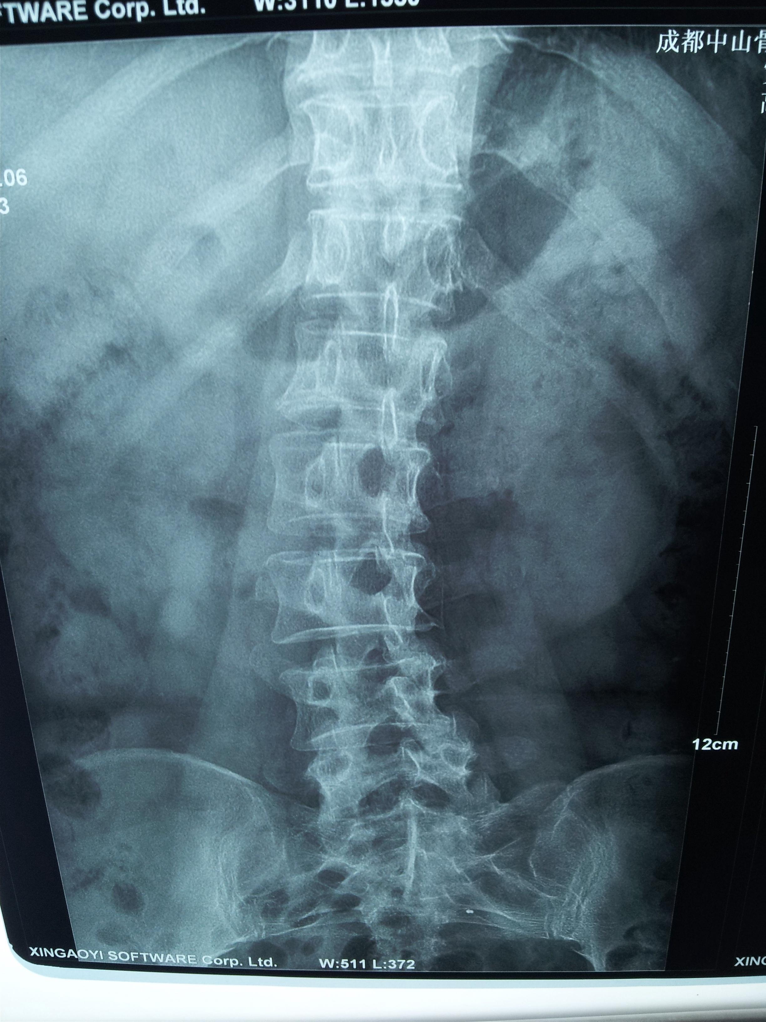 腰5/骶1椎间盘脱出症;腰4,5椎间盘突出