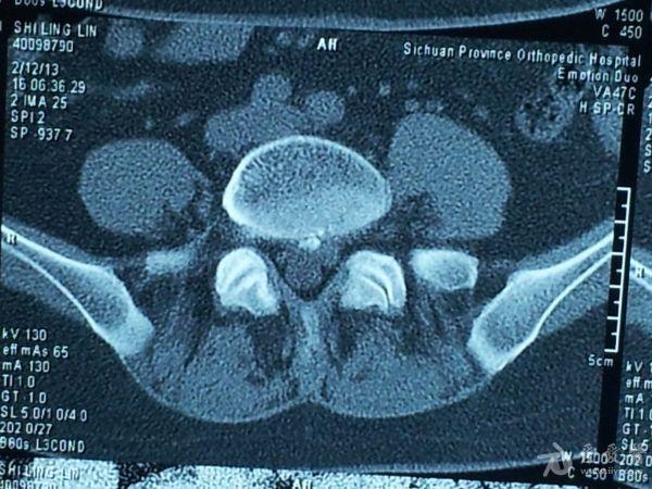 腰5/骶1椎间盘脱出症；腰4、5椎间盘突出。