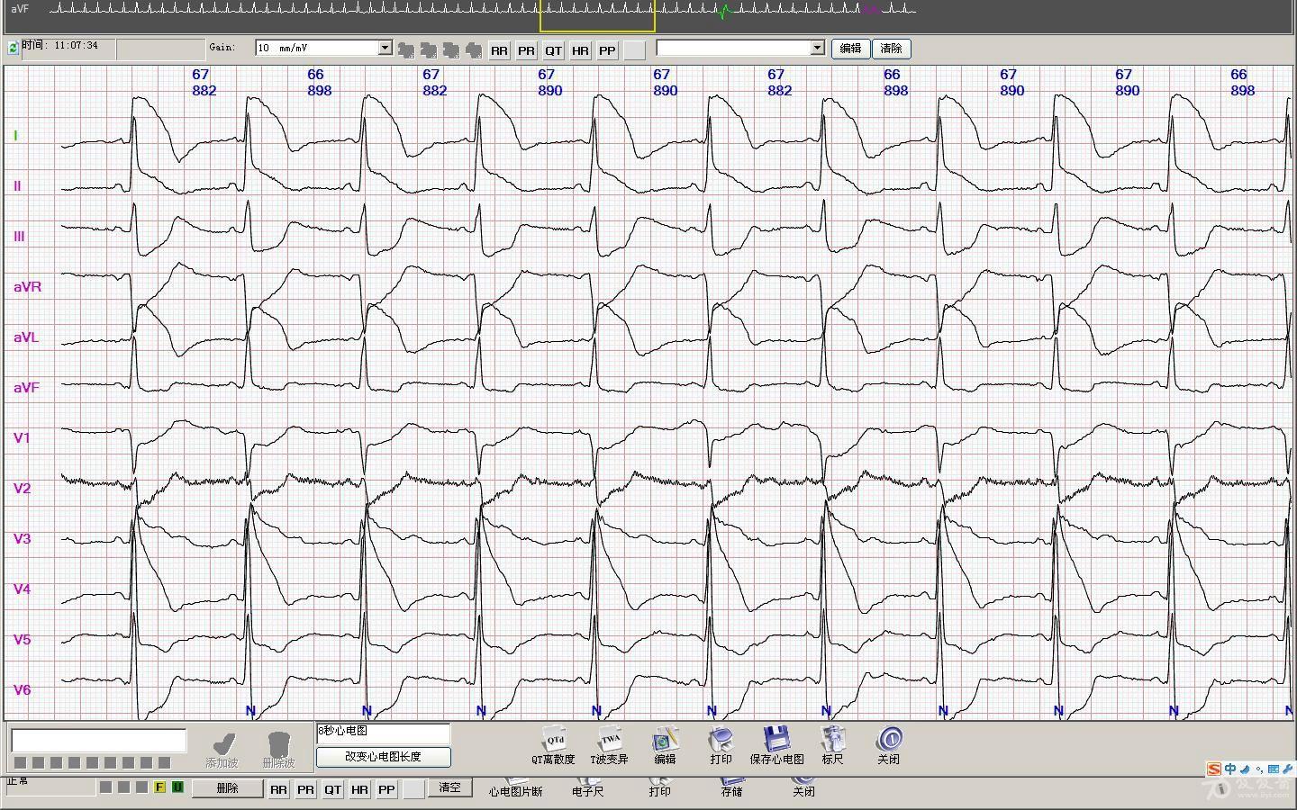 动态心电图记录到的心绞痛发作过程