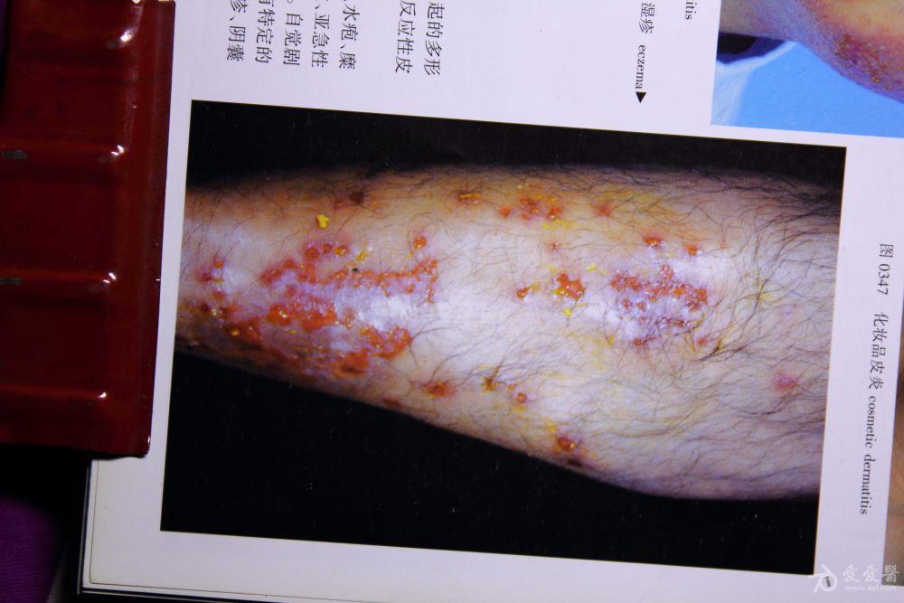 求湿疹样皮炎图谱