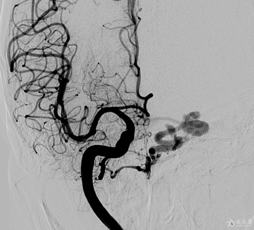 一例硬脑膜动静脉瘘病人介入治疗