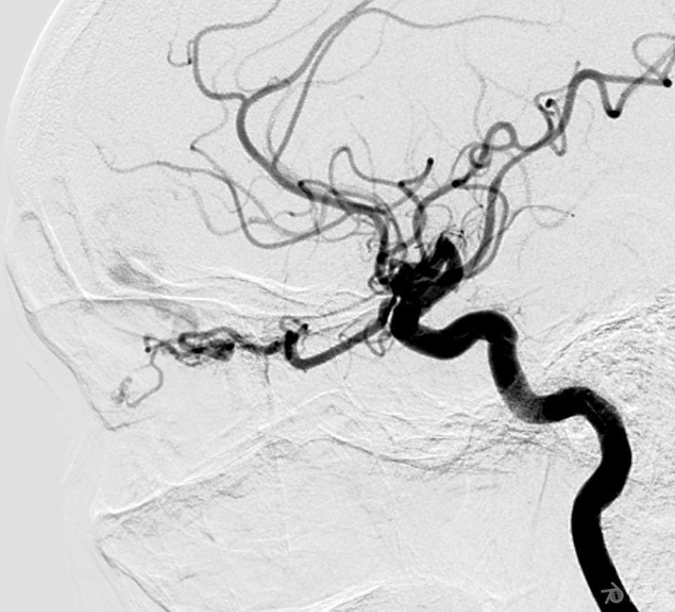 一例硬脑膜动静脉瘘病人介入治疗