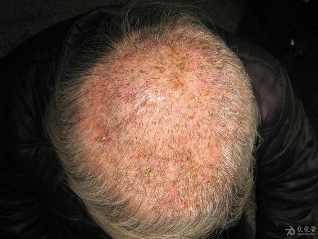 皮肤病头癣一例