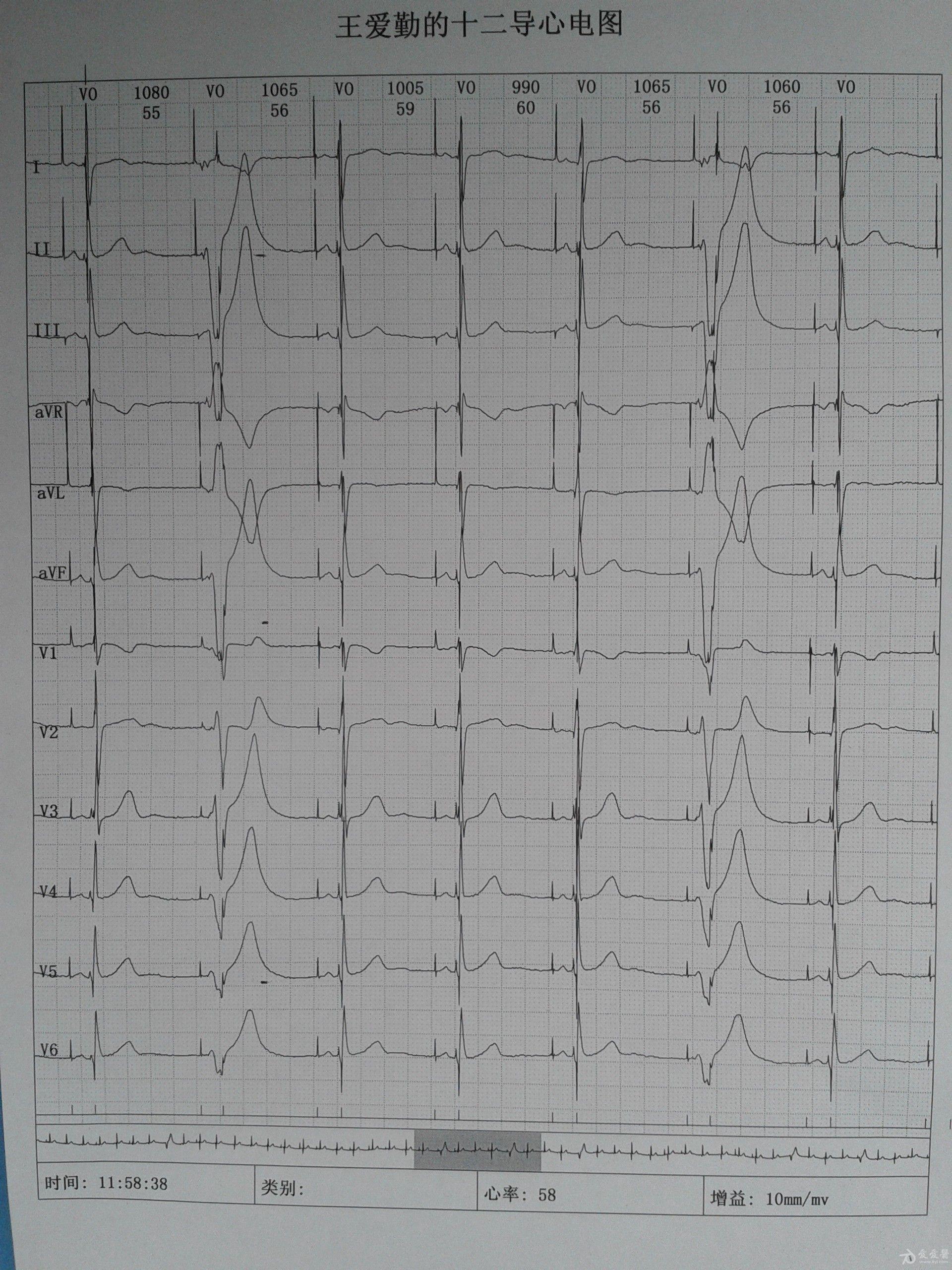 双腔起搏器心电图图片