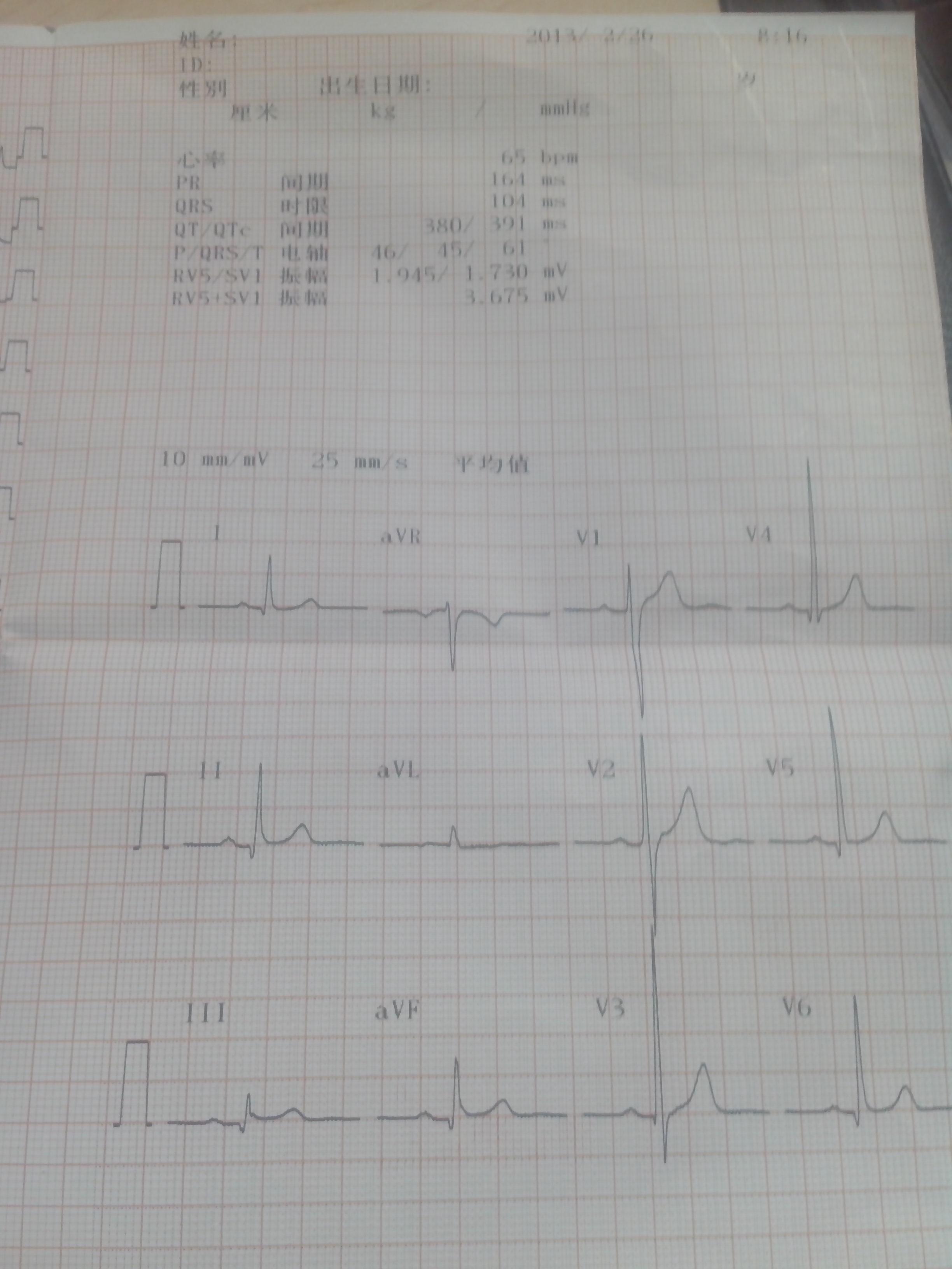 麻煩看一下我的心電圖是否正常有高血壓