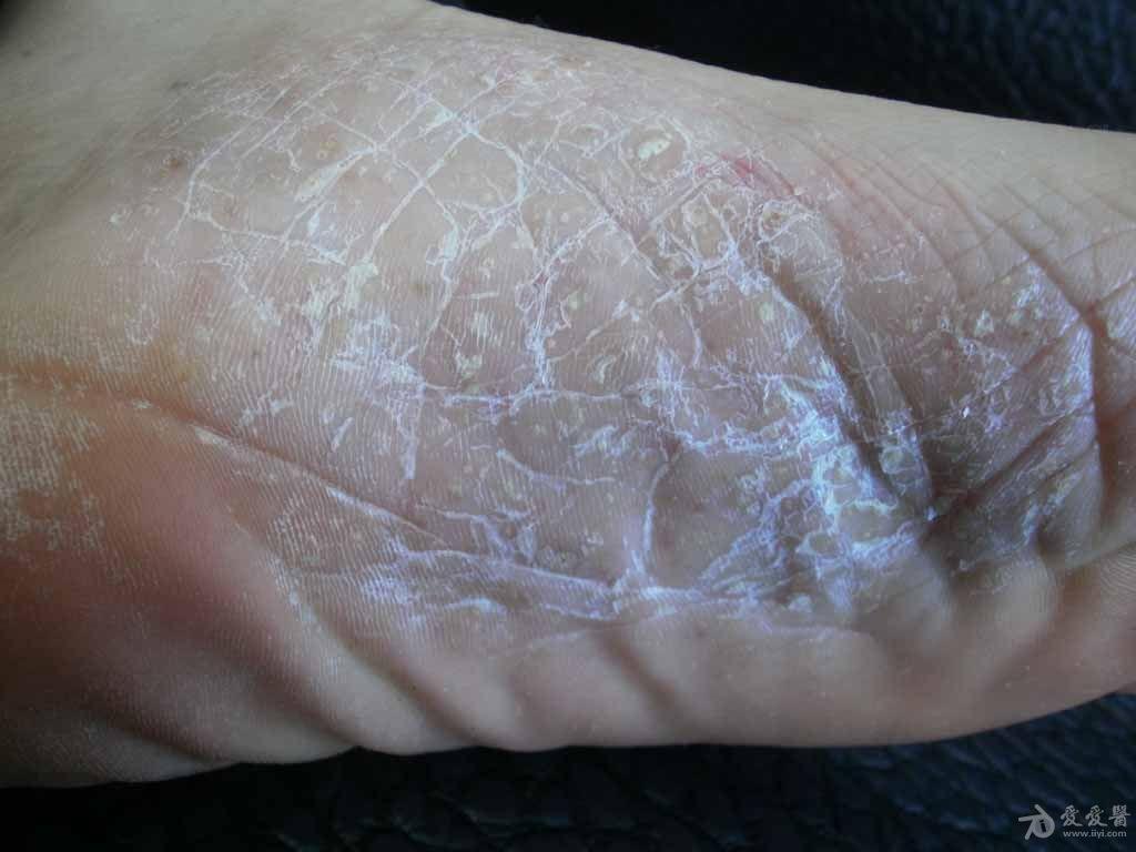 典型病例:银屑病伴掌跖脓疱病.