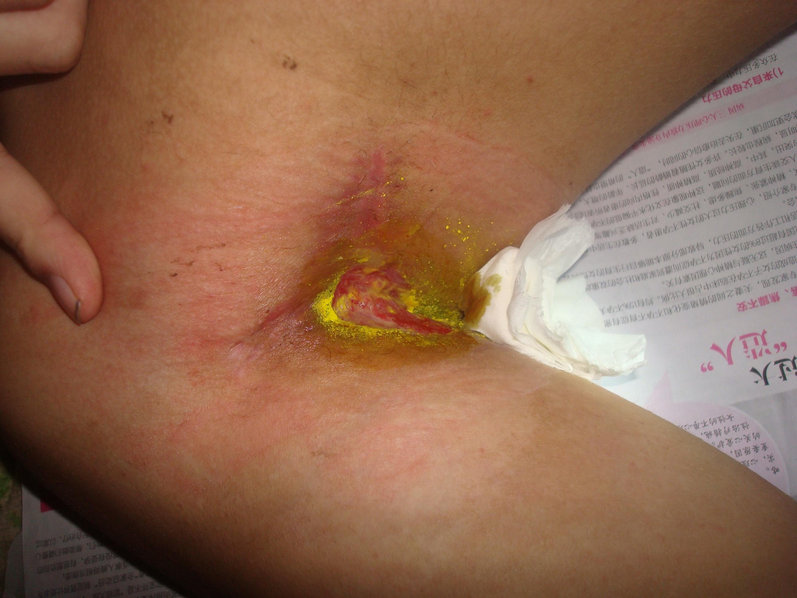 腋臭术后缝合裂开一月求治疗方法