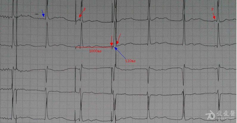 双腔起搏器心电图图片
