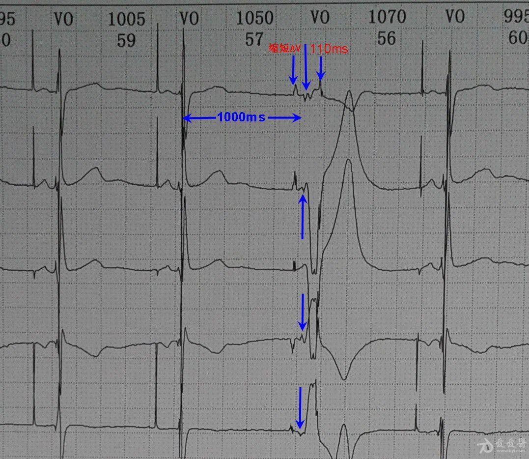 双腔起搏器心电图图片