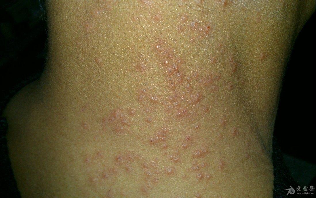 慢性湿疹急性发作