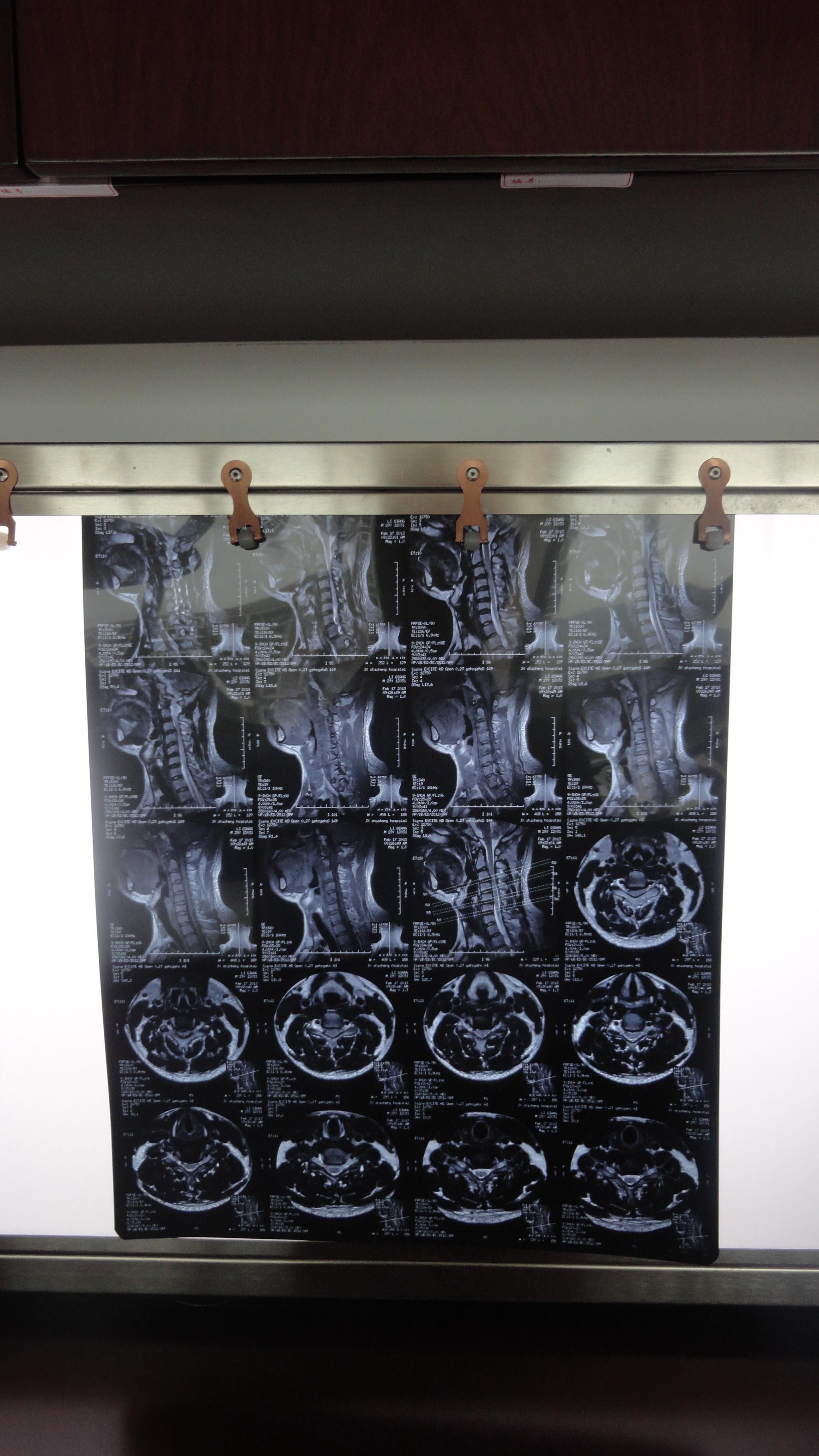 脊髓型颈椎病核磁图片图片