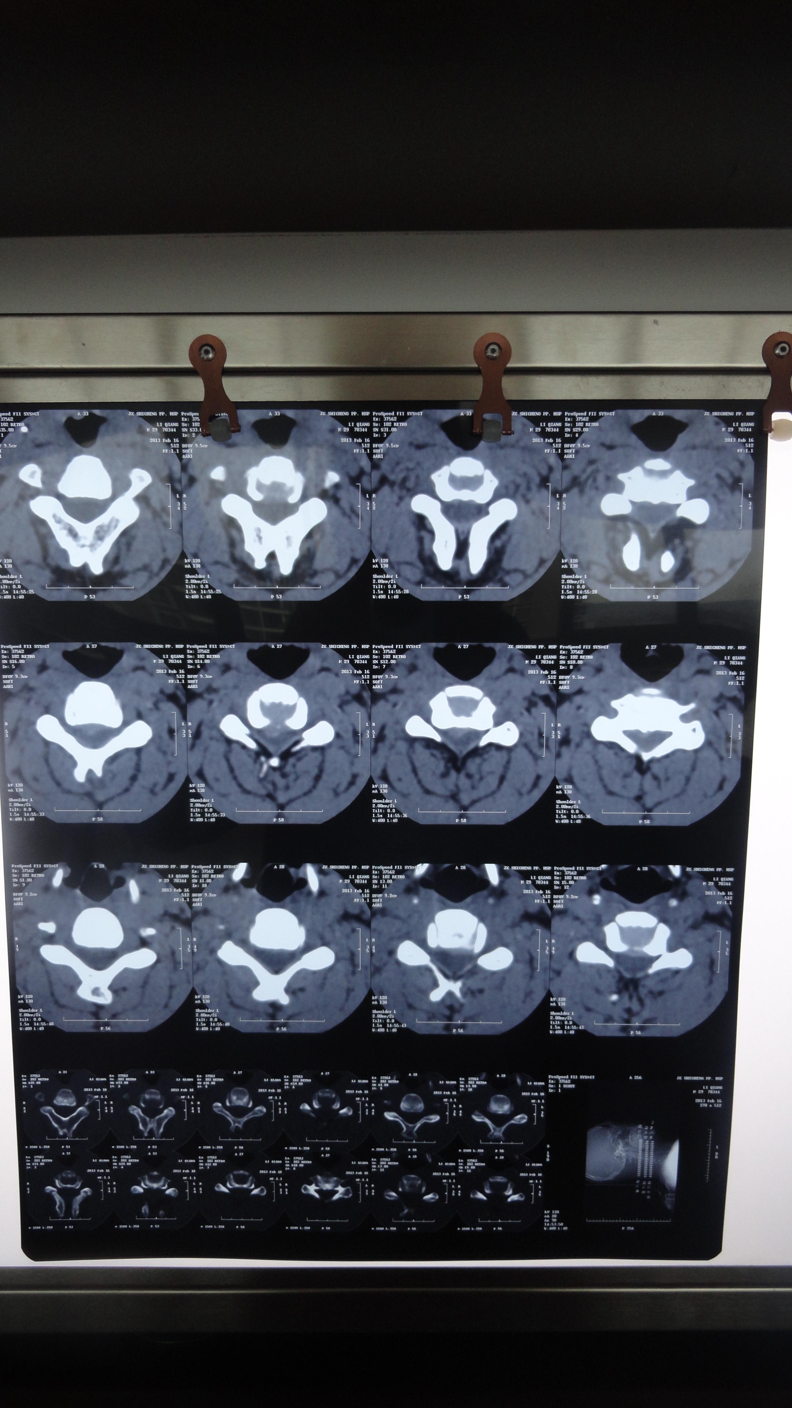 脊髓型颈椎病磁共振图片