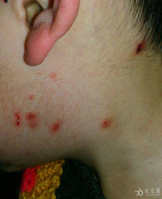 小儿痒疹求治疗