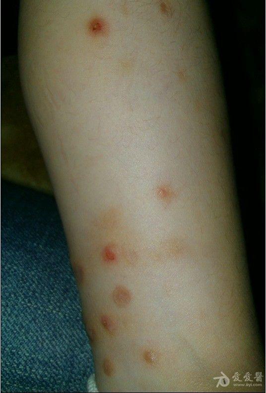 小儿痒疹求治疗