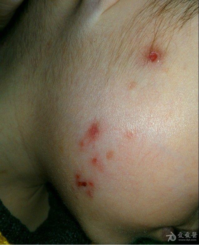 小儿痒疹求治疗