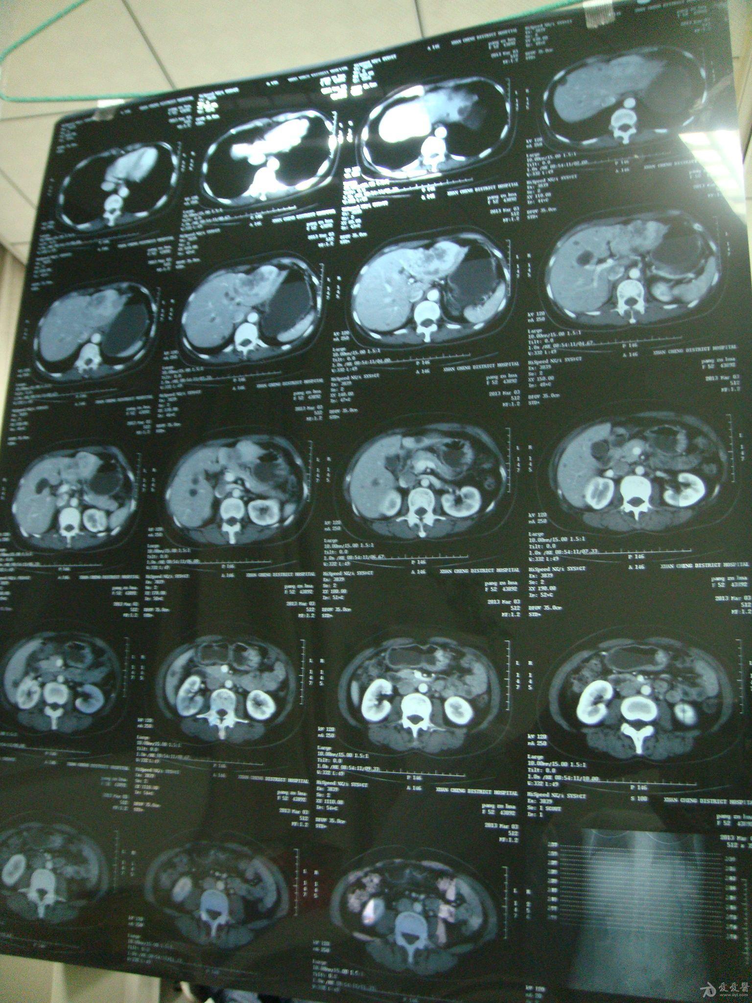 乳癌术后5年余考虑肝转移ct已经出来跪求治疗