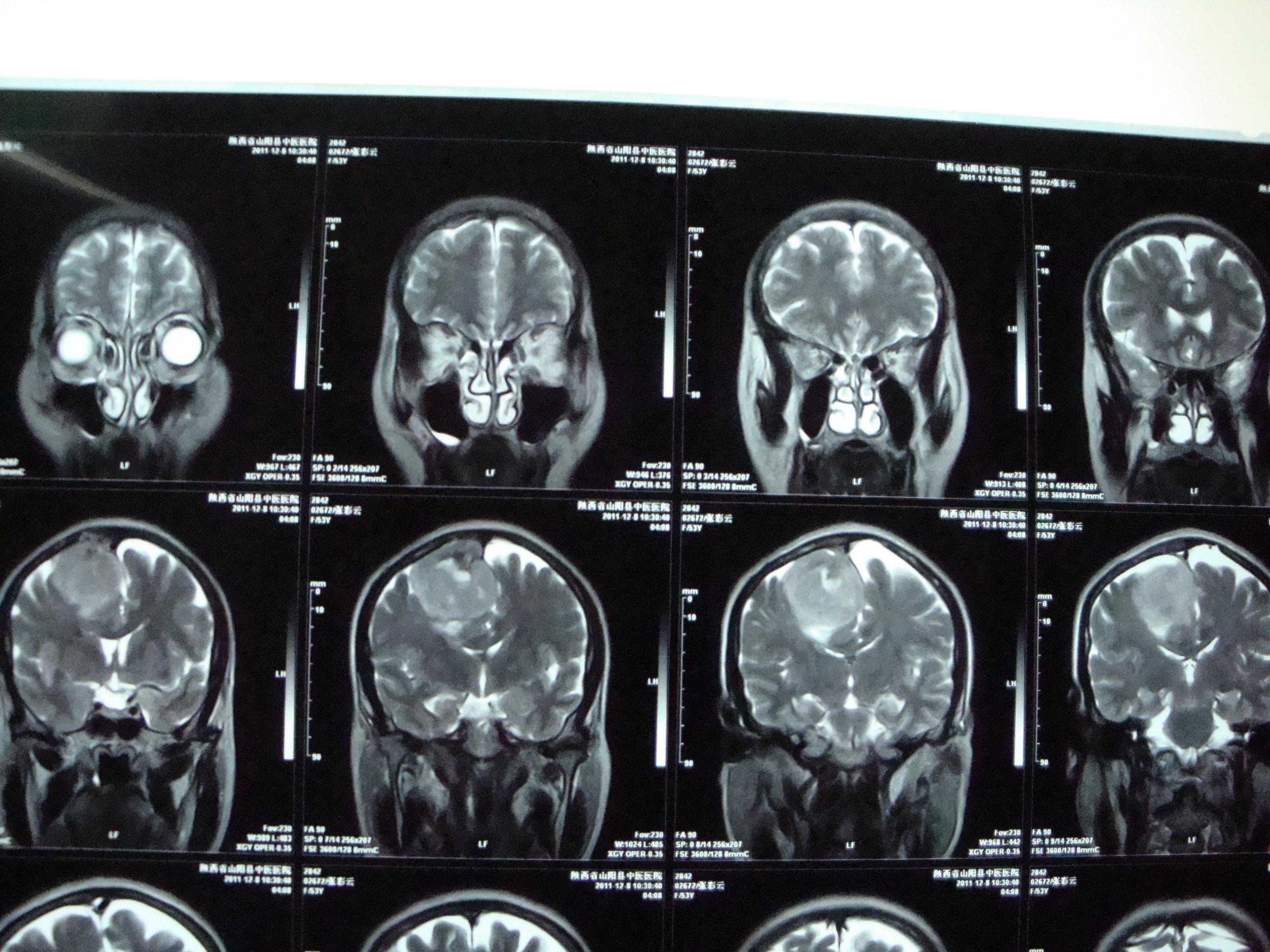 脑脊髓疾病右侧顶叶窦镰旁脑膜瘤一例