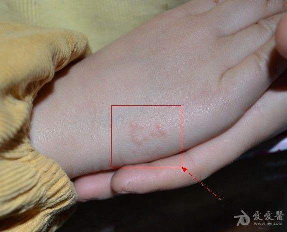宝宝手背上出现小红疹半月,请问是什么病,内有图