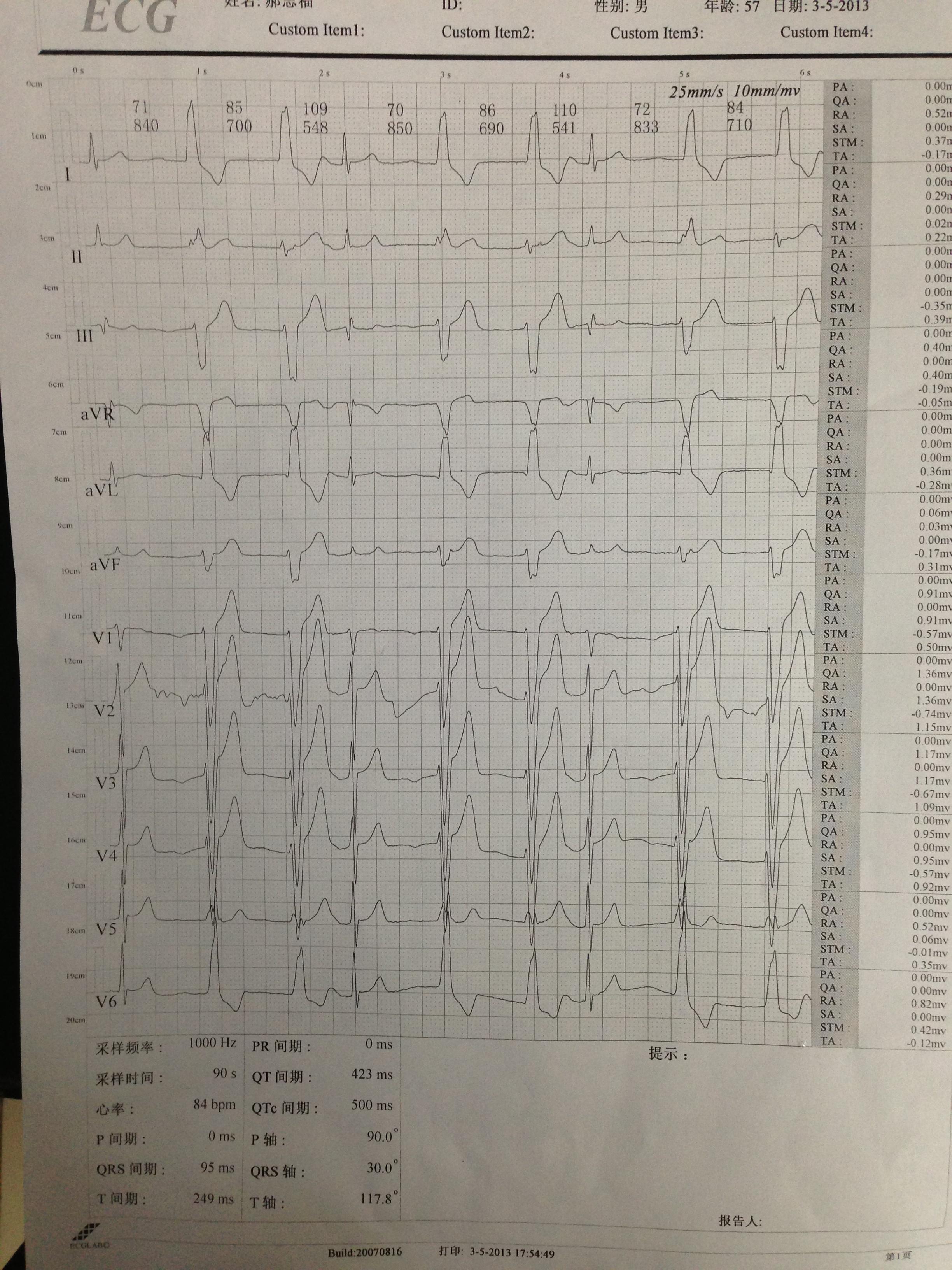 请trg shanyangchen nikkive看看这份心电图
