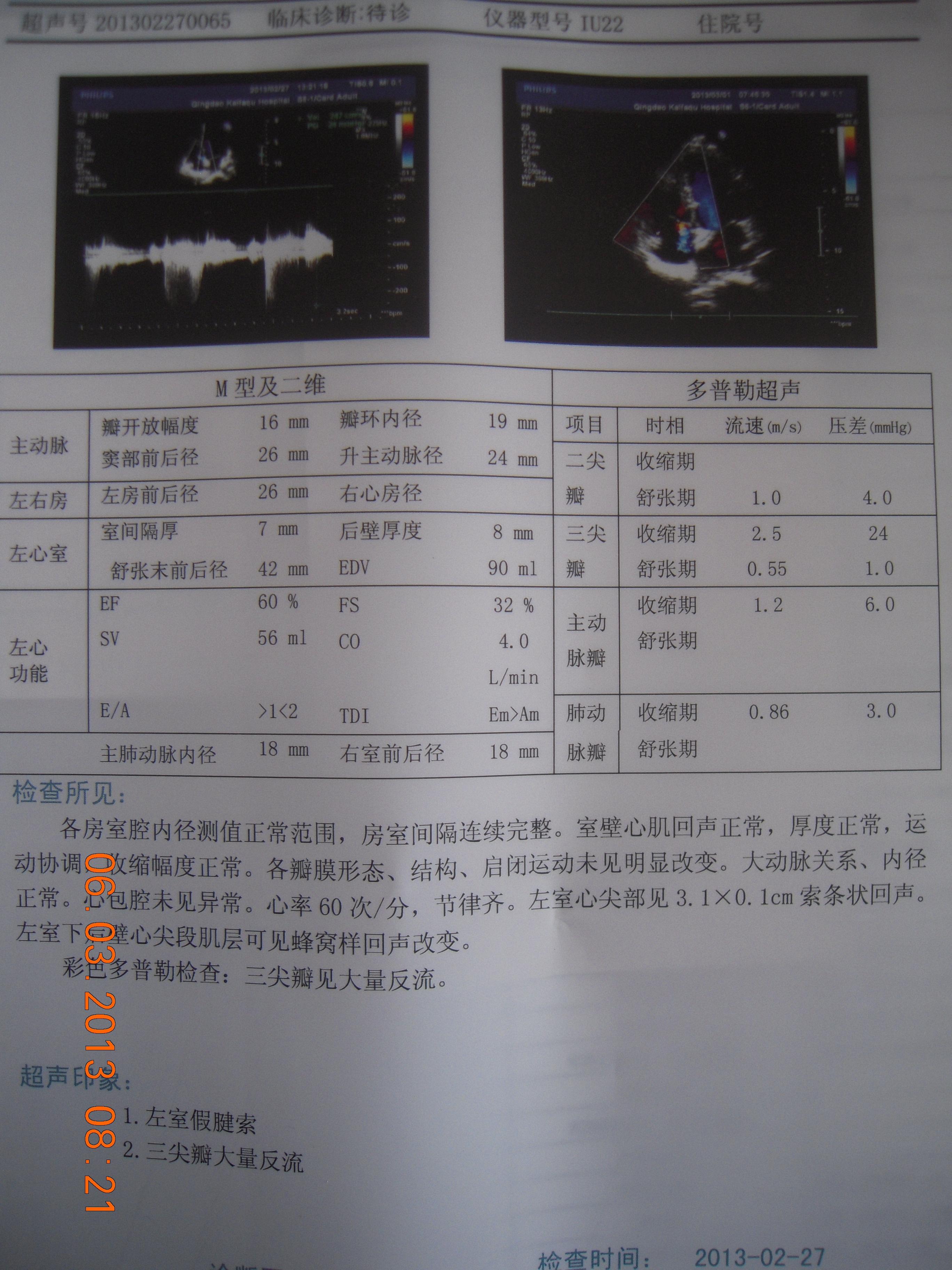 急求:三尖瓣大量反流原因