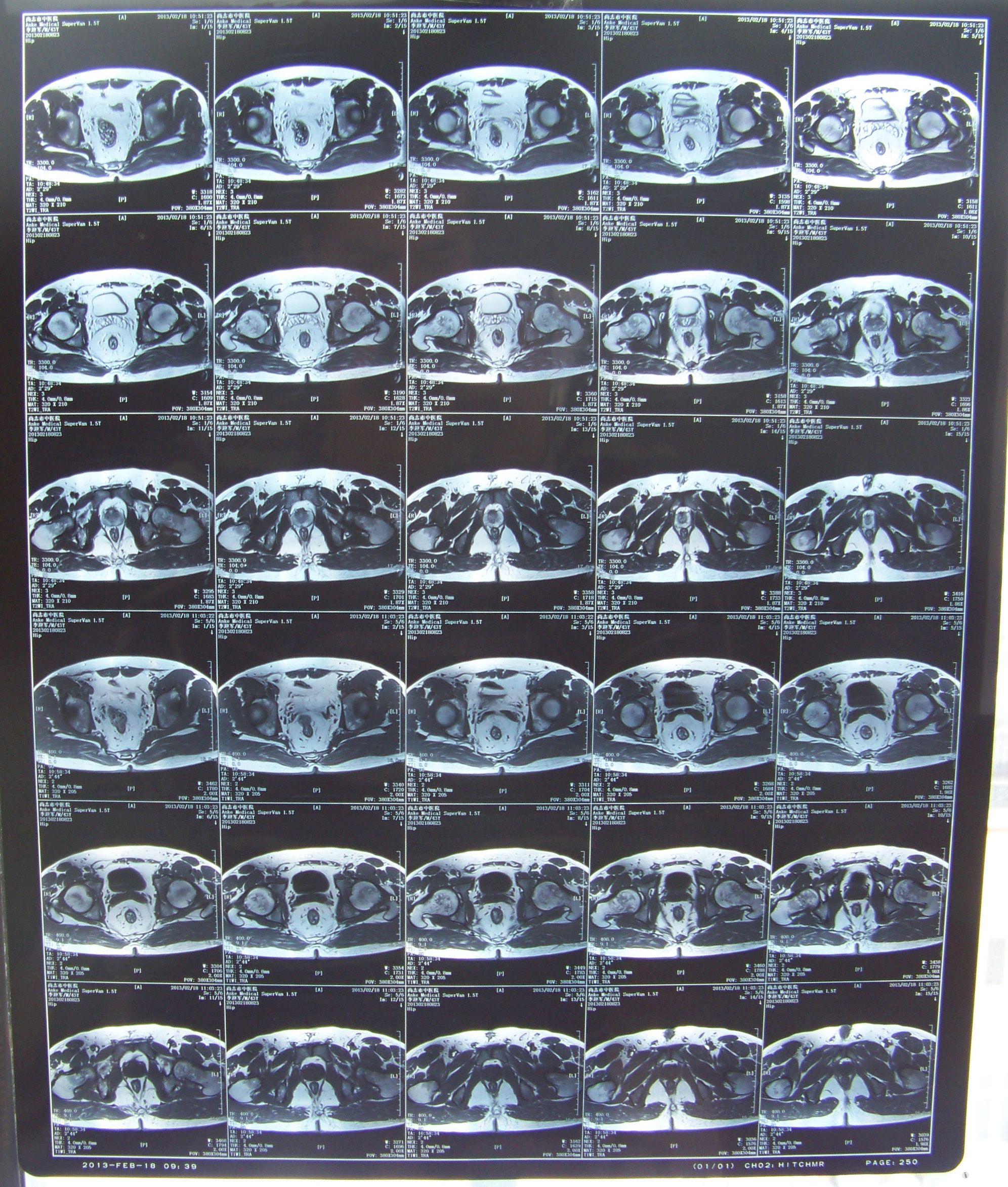 髋关节疼痛求帮助