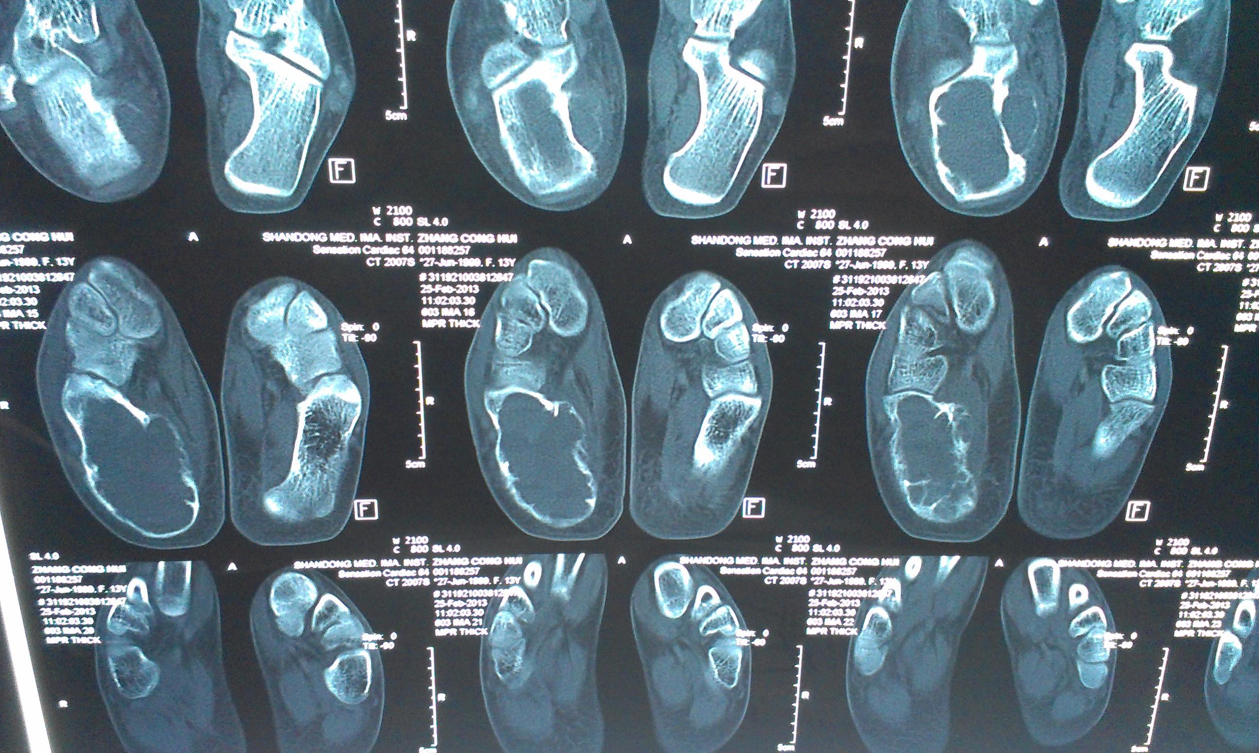 女16岁跟骨皮肤红肿疼痛无外伤病史