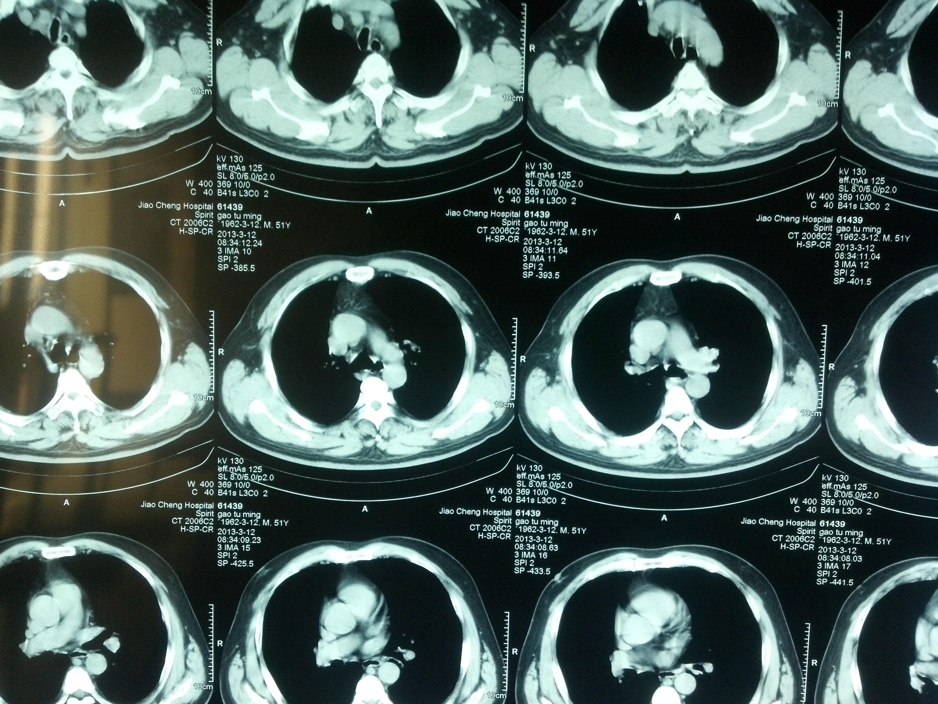 前上纵隔增宽高手来看看