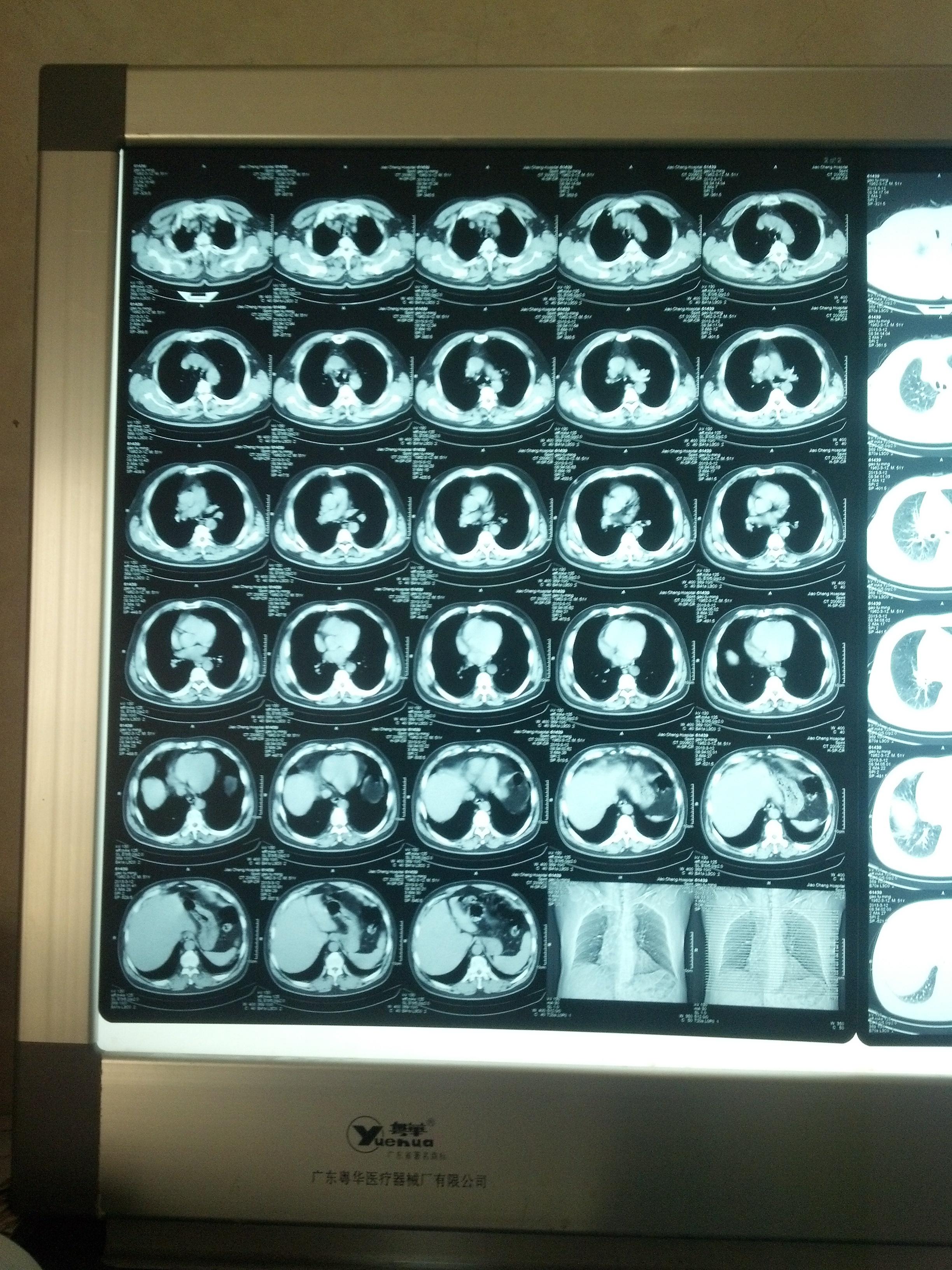 前上纵隔增宽高手来看看