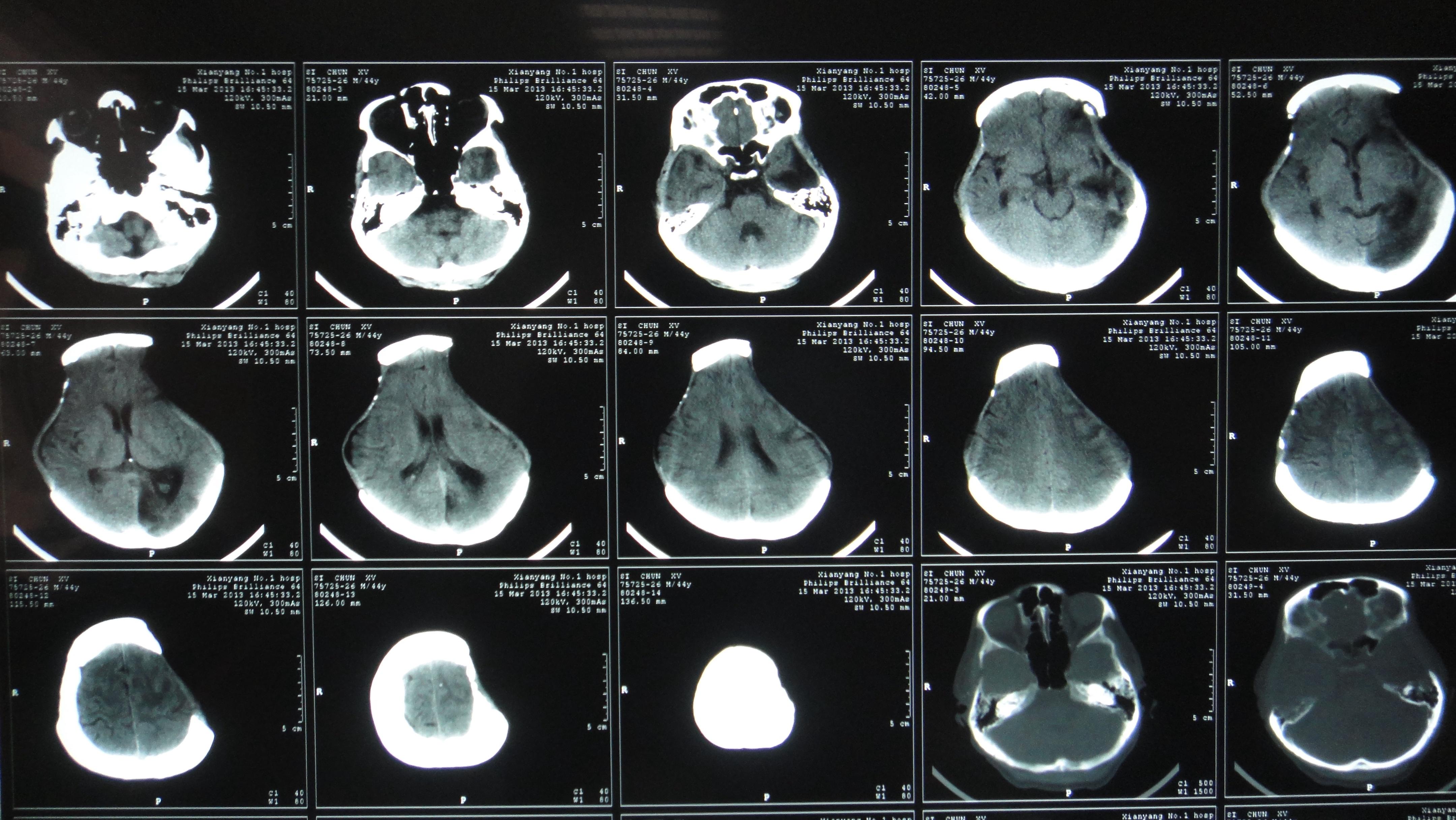 双侧大骨窗减压颅骨修补