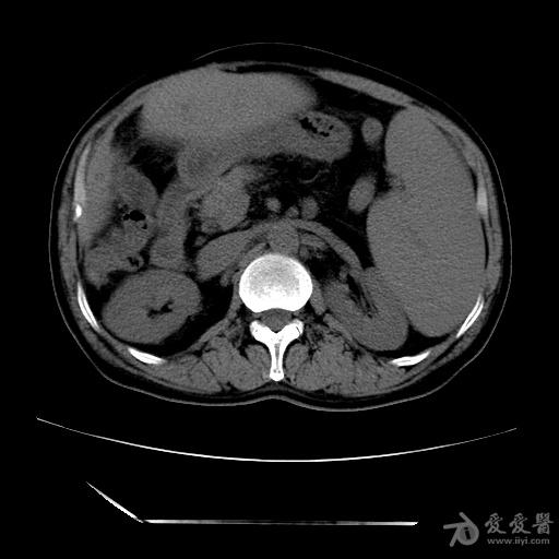 多发肝内胆管结石求良策