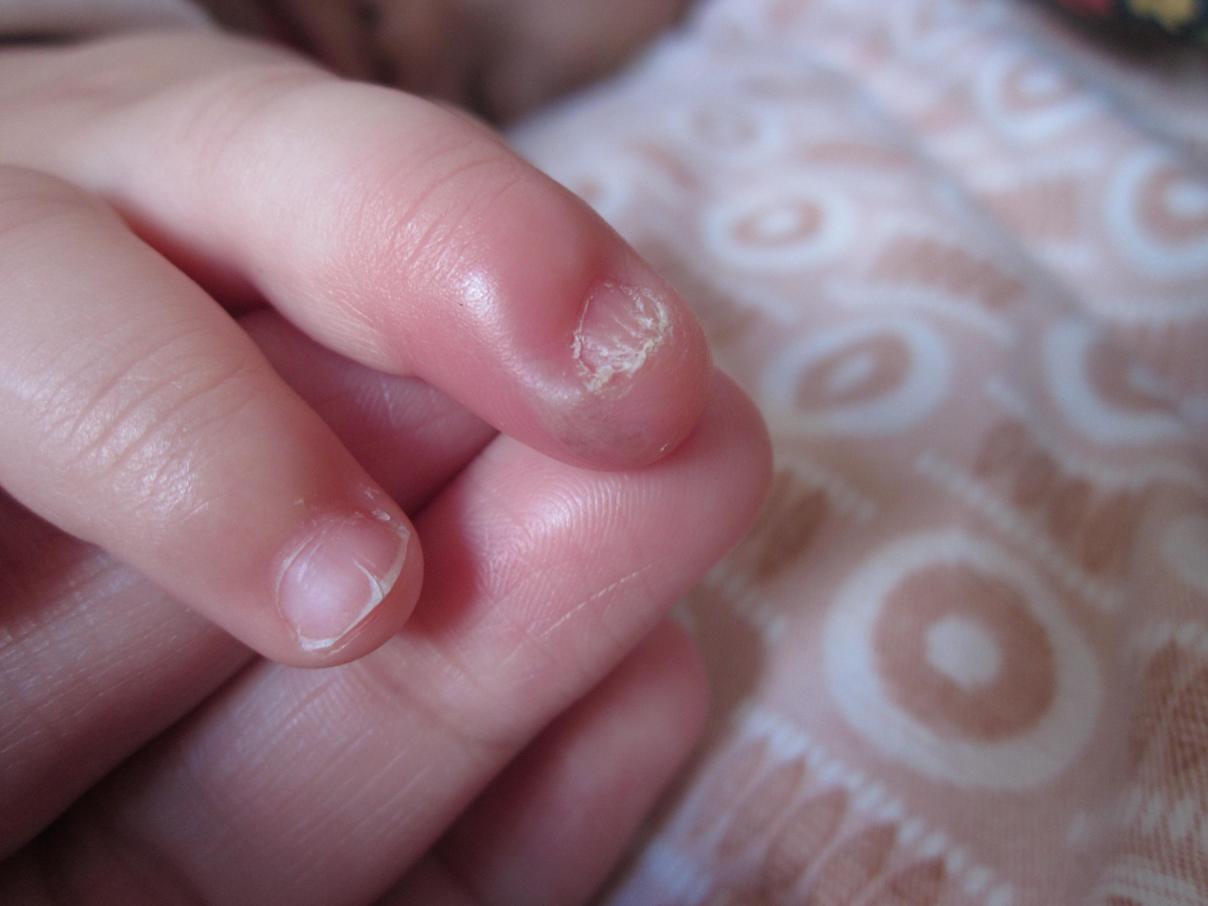 手指滑膜炎的症状图片图片