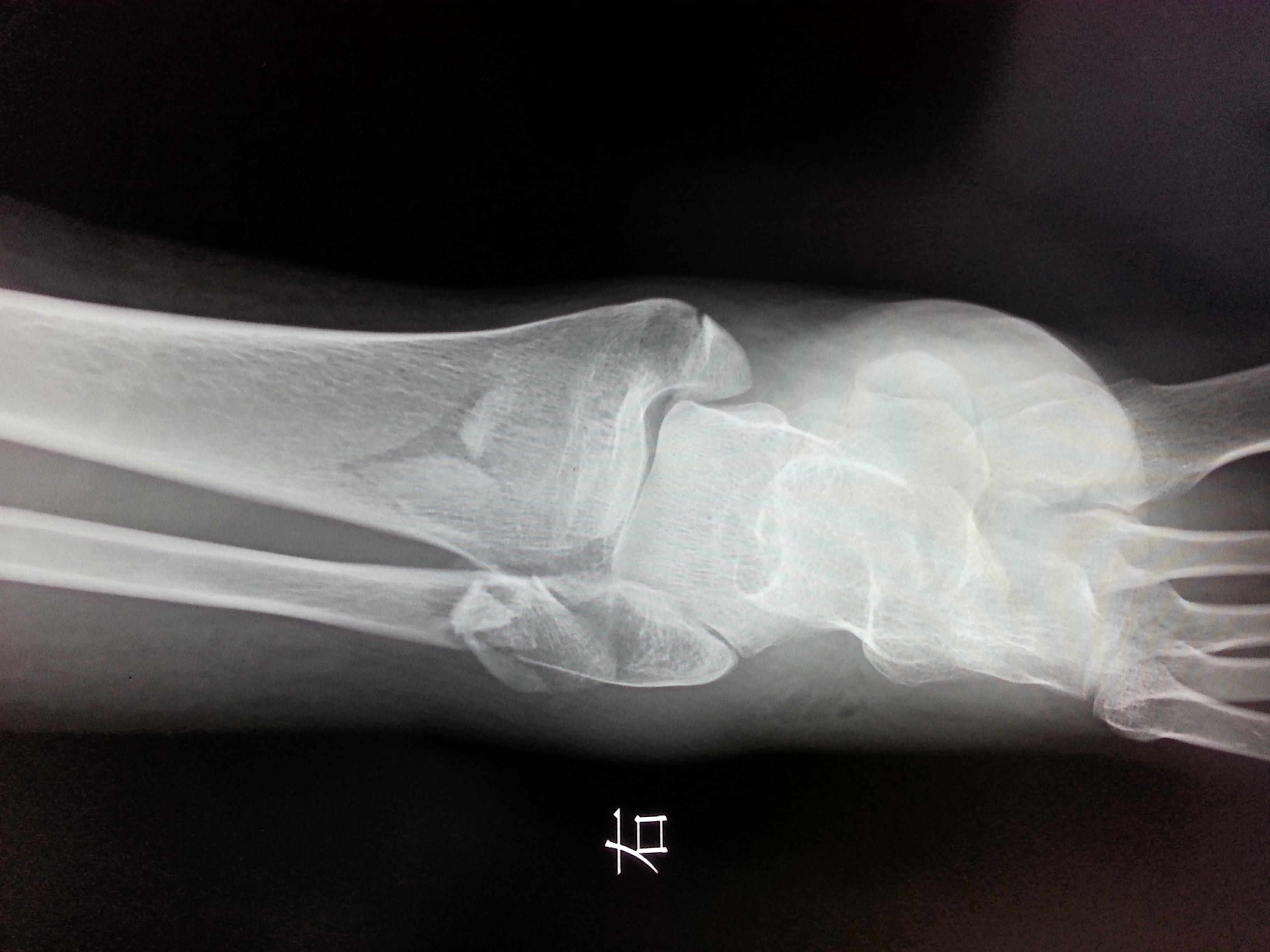 妊娠踝关节骨折该如何治疗