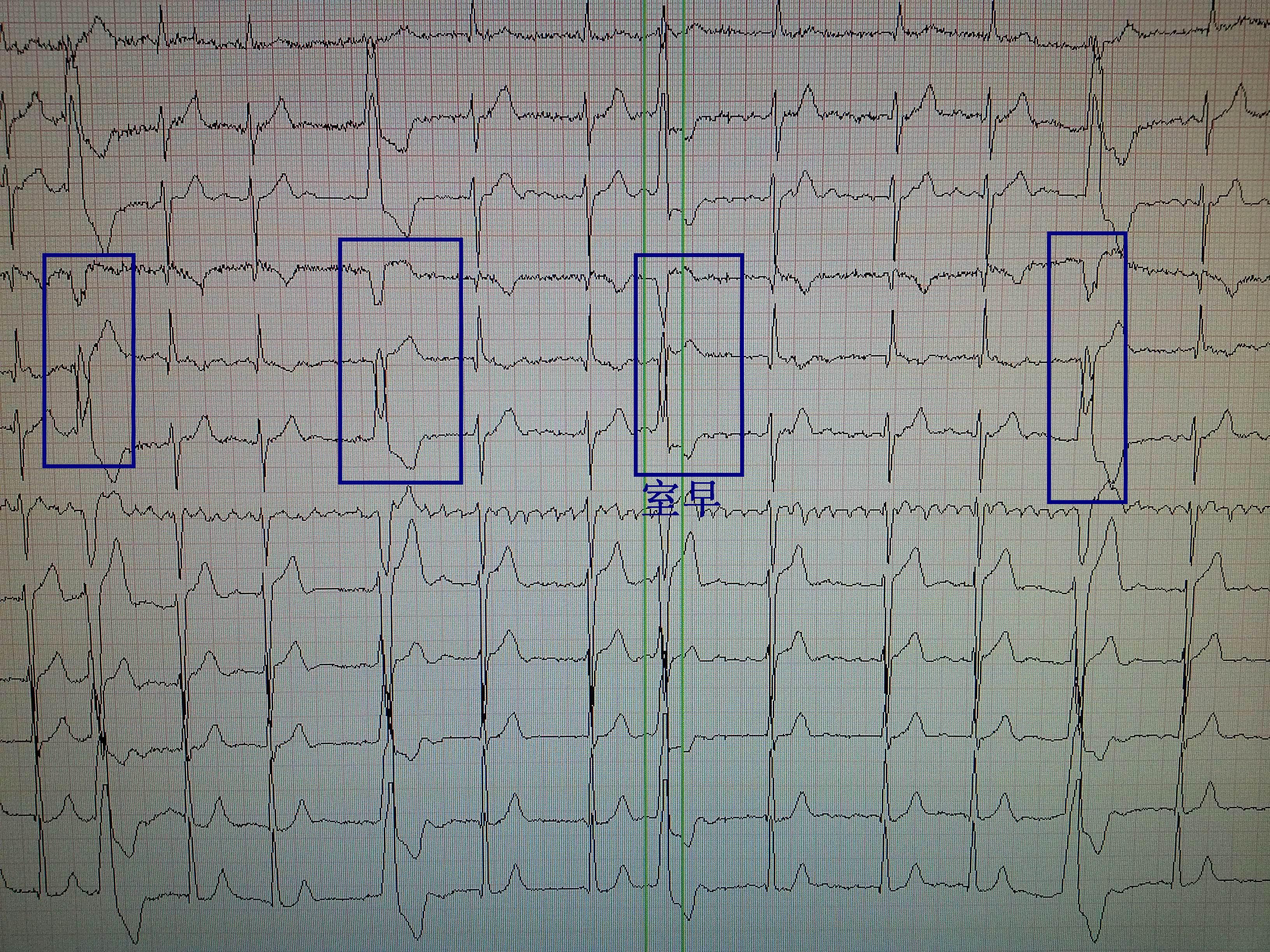 起搏心律心电图特征图片