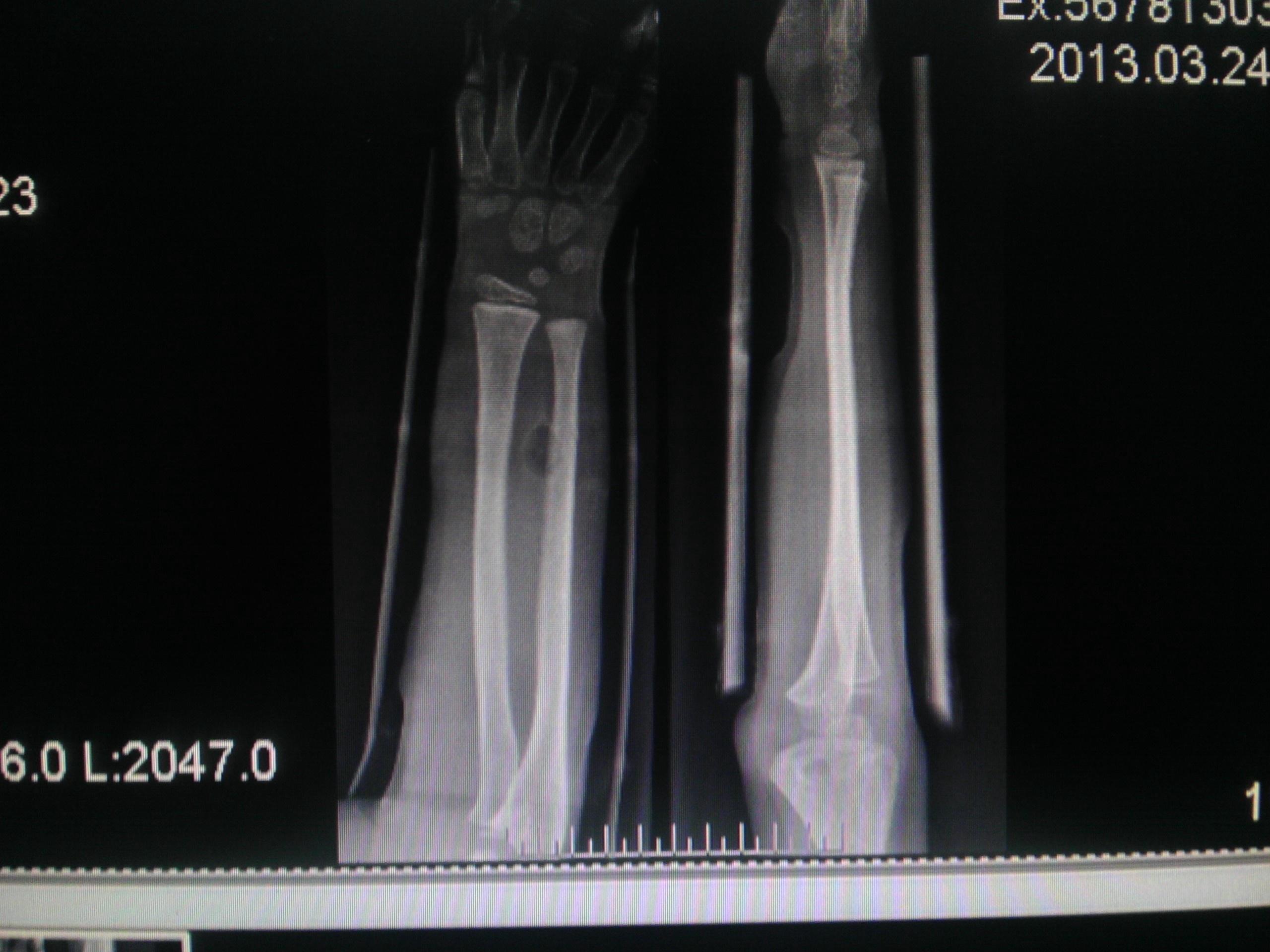 左桡骨远端青枝骨折图片