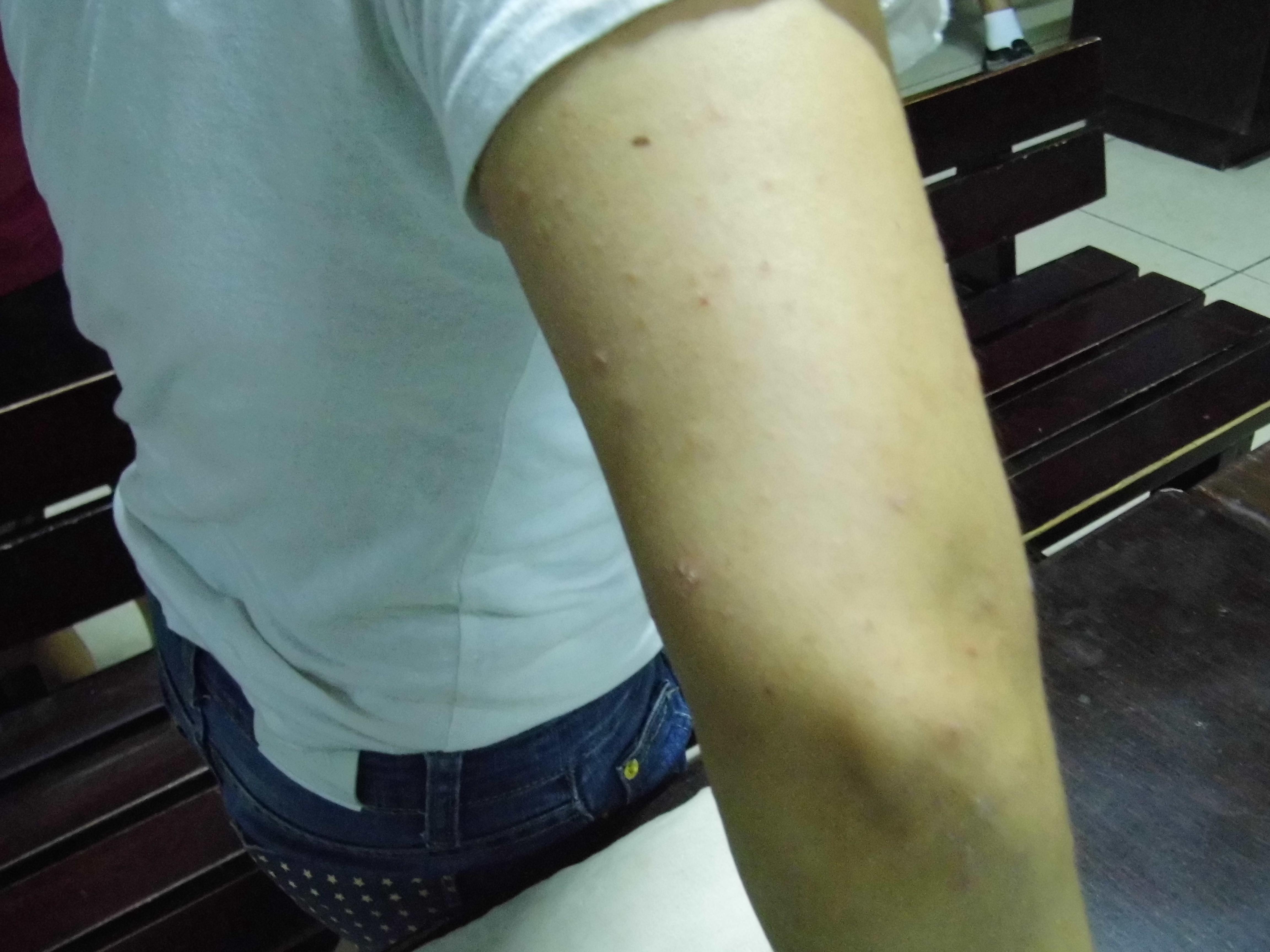 寻常型银屑病春季皮肤病病例征集