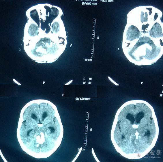 两例小脑出血并破入脑室,四脑室铸型,请教. - 神经外科专业讨论版 - 