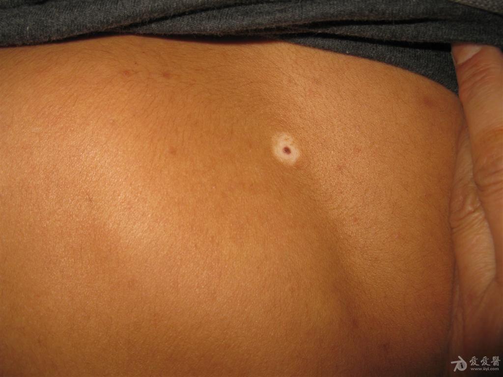 看图识病----------晕痣 - 皮肤及性传播疾病讨论版 - 爱爱医医学论坛
