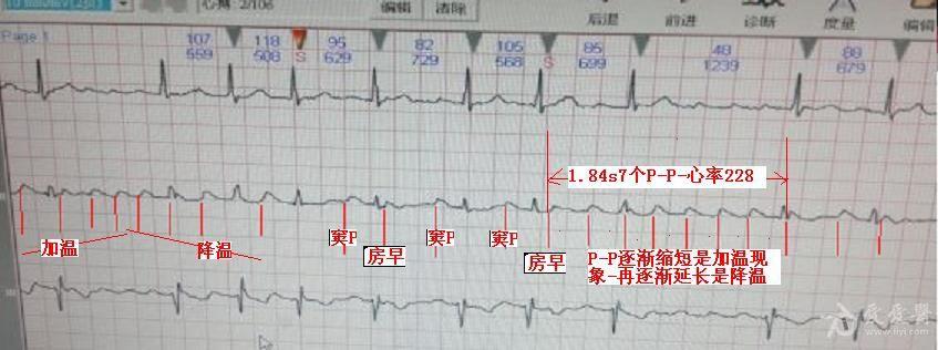 房扑的心电图表现图片